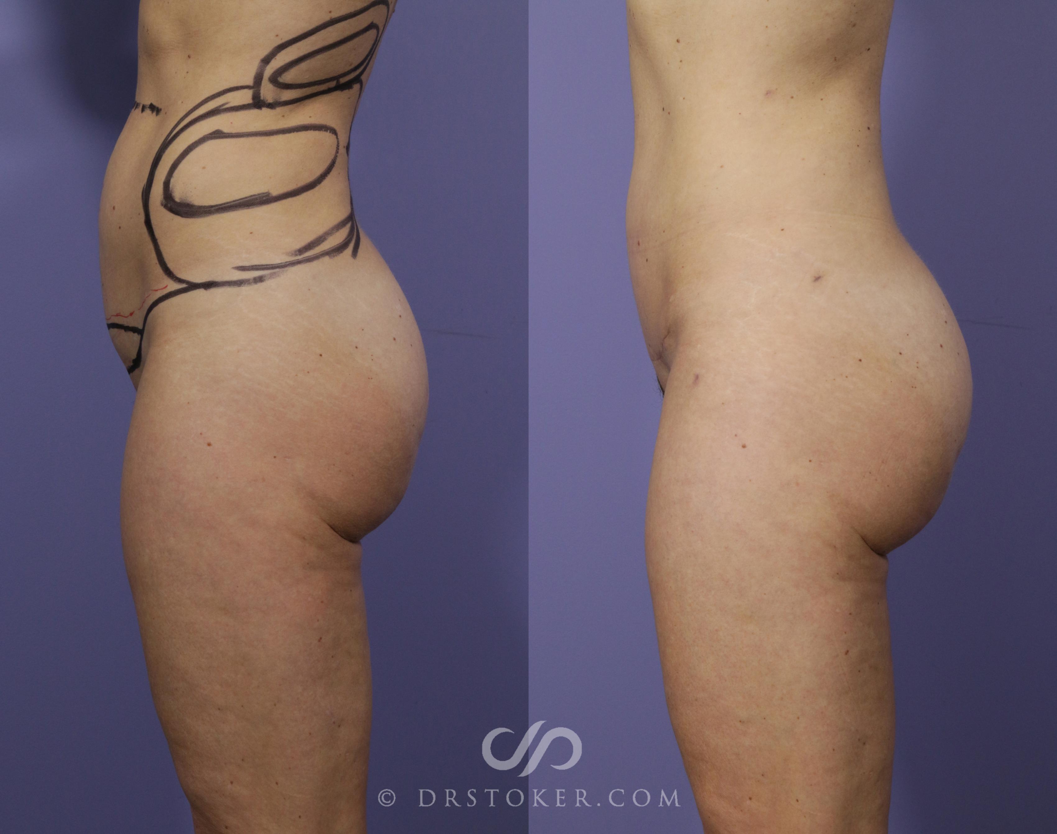Before & After Brazilian Butt Lift (Fat Grafts to Buttocks) Case 583 View #1 View in Los Angeles, CA