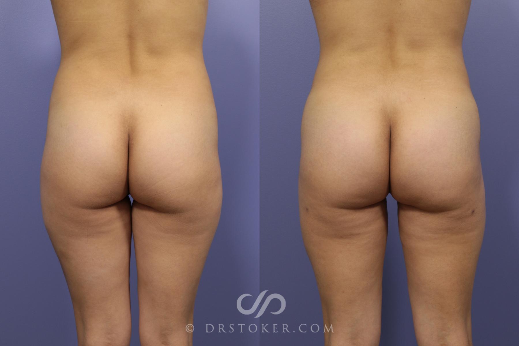 Before & After Brazilian Butt Lift (Fat Grafts to Buttocks) Case 584 View #1 View in Los Angeles, CA