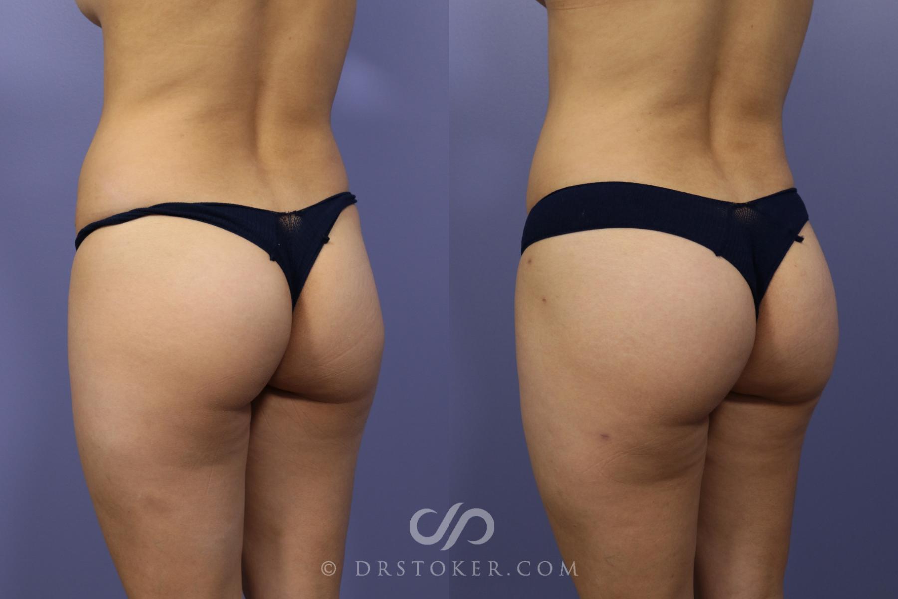 Before & After Brazilian Butt Lift (Fat Grafts to Buttocks) Case 585 View #1 View in Los Angeles, CA