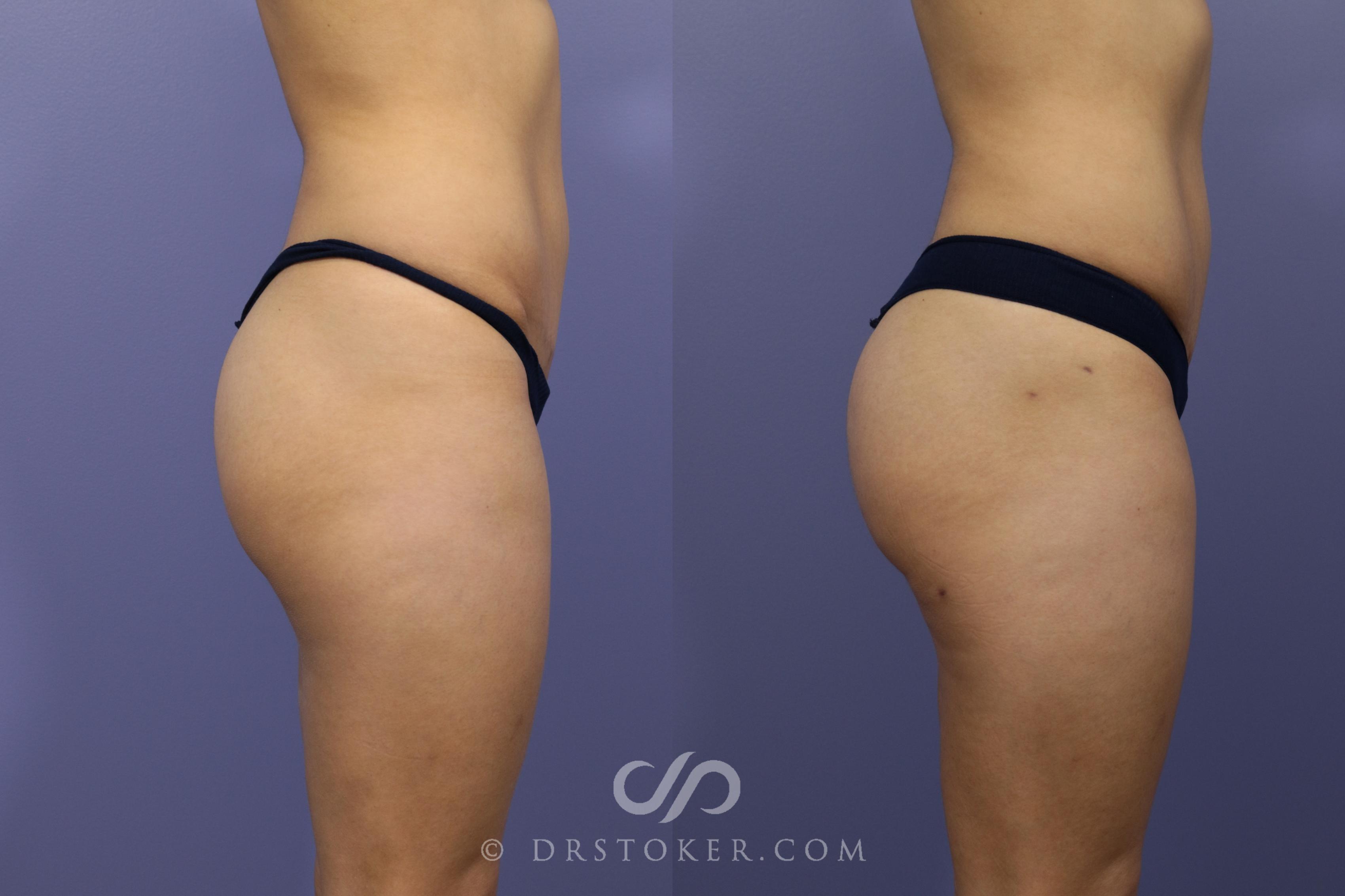 Before & After Brazilian Butt Lift (Fat Grafts to Buttocks) Case 586 View #1 View in Los Angeles, CA