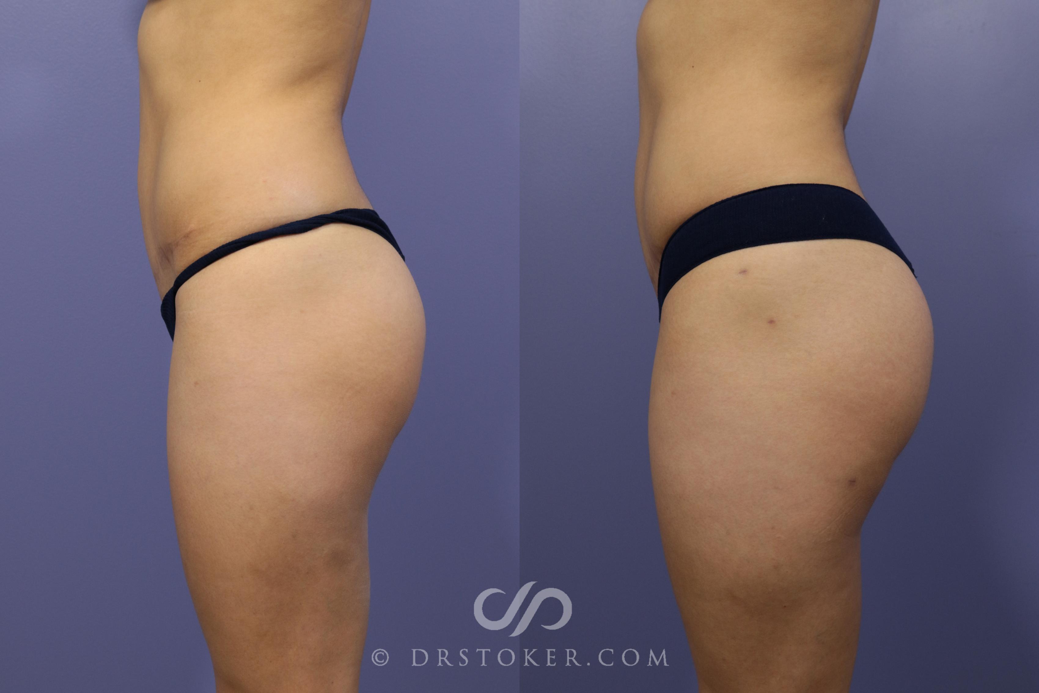 Before & After Brazilian Butt Lift (Fat Grafts to Buttocks) Case 587 View #1 View in Los Angeles, CA
