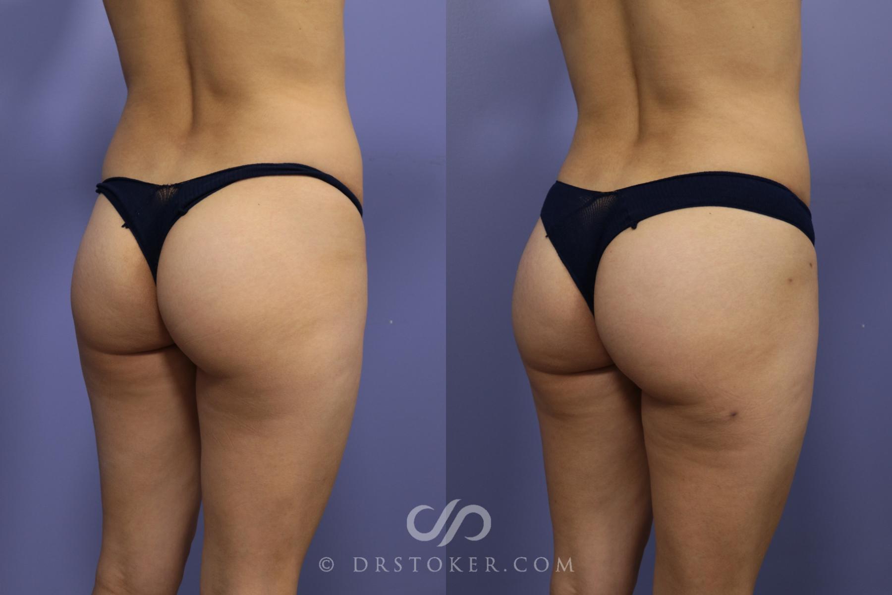 Before & After Brazilian Butt Lift (Fat Grafts to Buttocks) Case 588 View #1 View in Los Angeles, CA