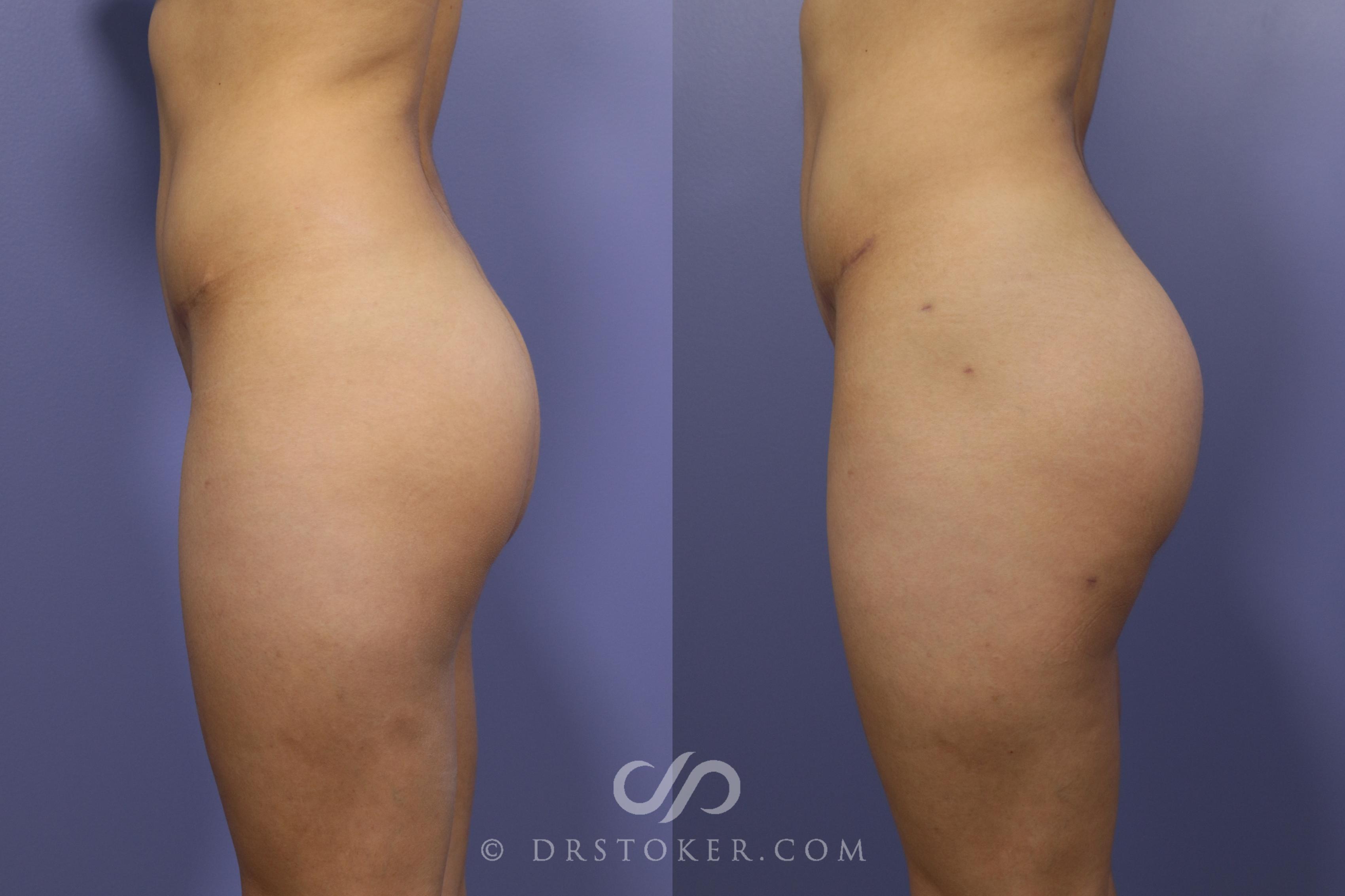 Before & After Brazilian Butt Lift (Fat Grafts to Buttocks) Case 589 View #1 View in Los Angeles, CA