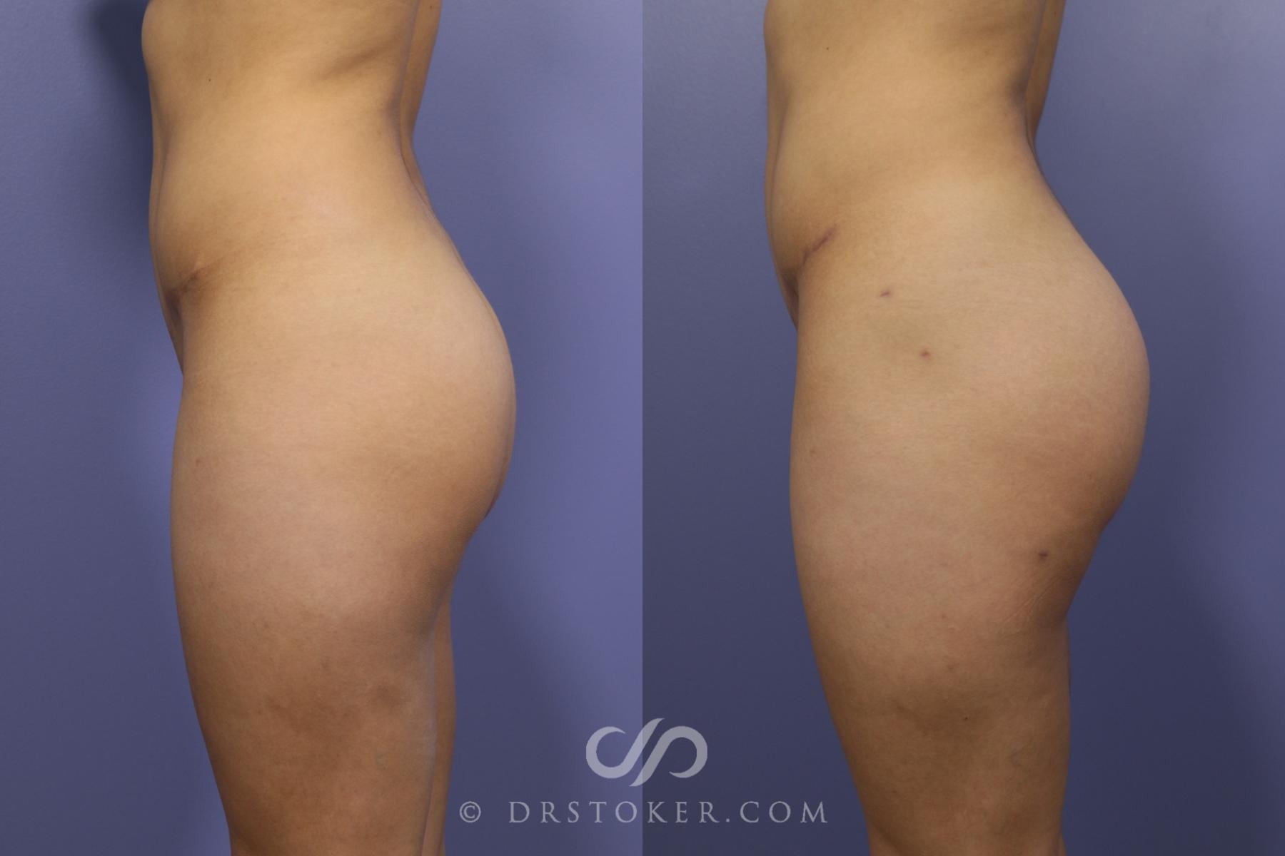 Before & After Brazilian Butt Lift (Fat Grafts to Buttocks) Case 589 View #1 View in Los Angeles, CA