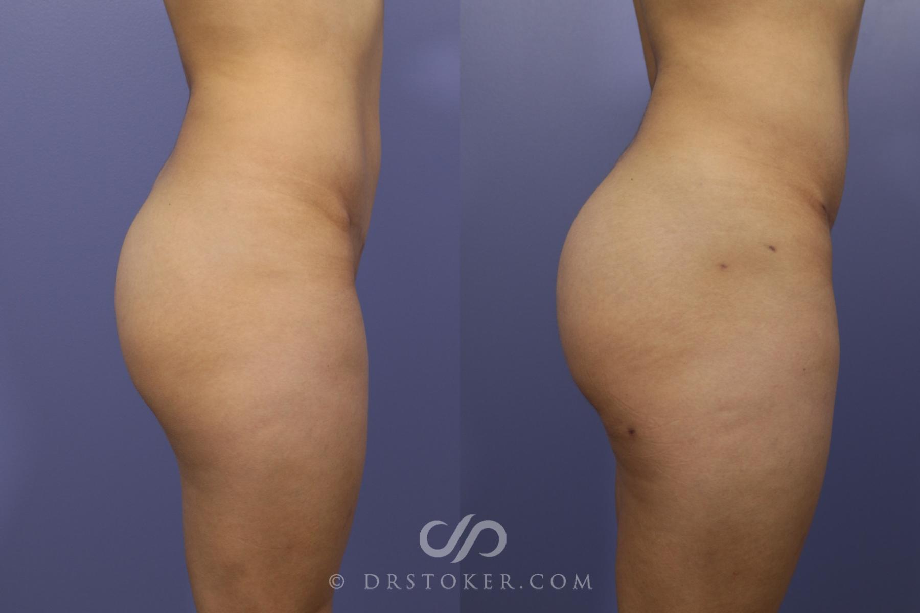 Brazilian Butt Lift (Fat Grafts to Buttocks) Before and After Pictures Case  585, Los Angeles, CA