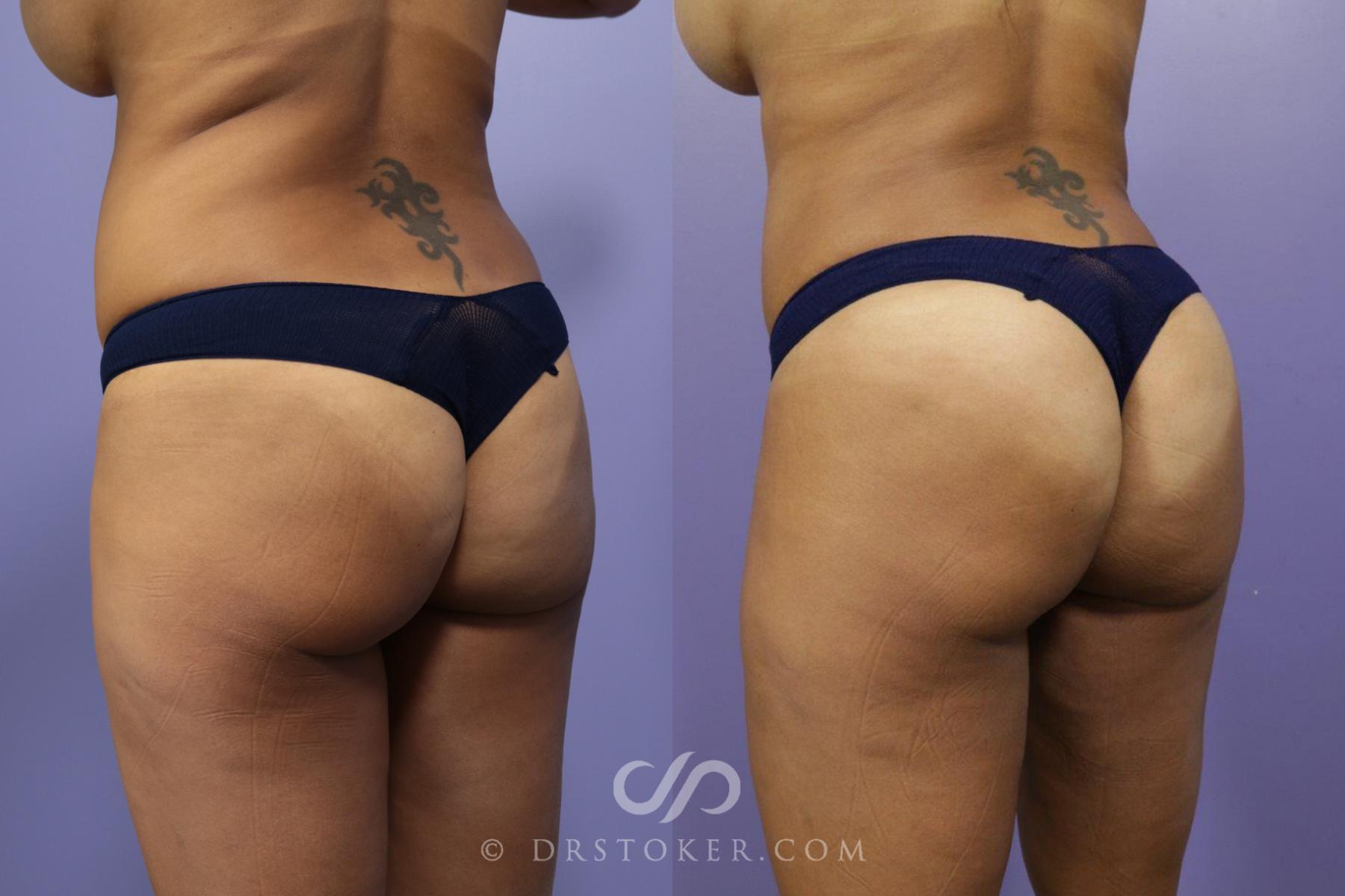 Before & After Brazilian Butt Lift (Fat Grafts to Buttocks) Case 593 View #1 View in Los Angeles, CA