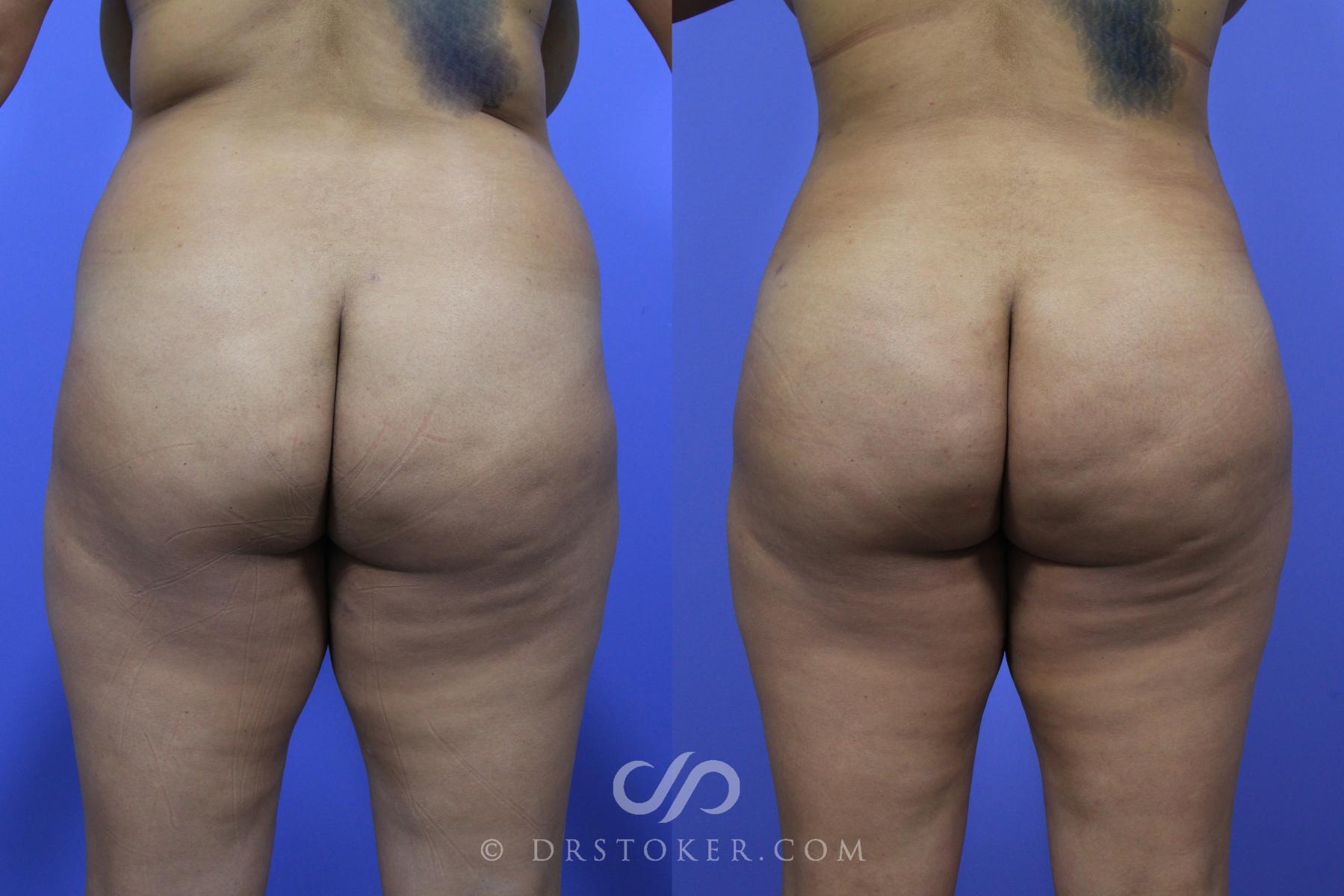 Before & After Brazilian Butt Lift (Fat Grafts to Buttocks) Case 594 View #1 View in Los Angeles, CA
