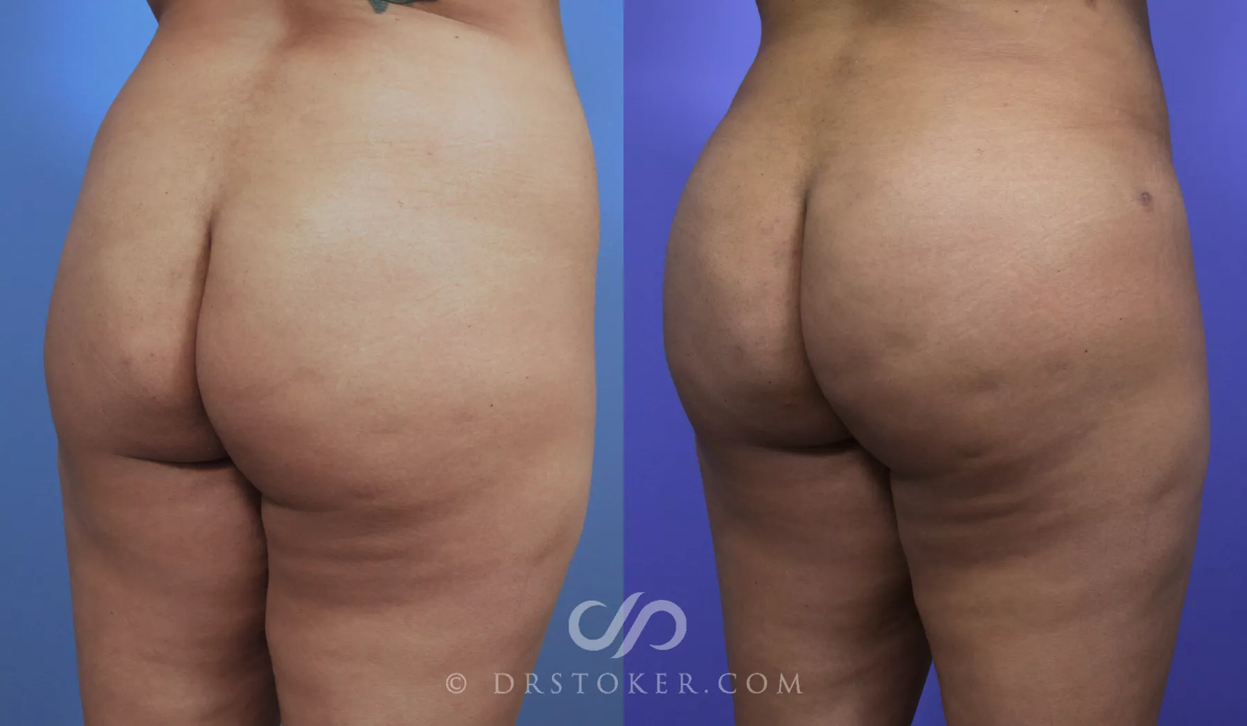 Brazilian Butt Lift (Fat Grafts to Buttocks) Before and After