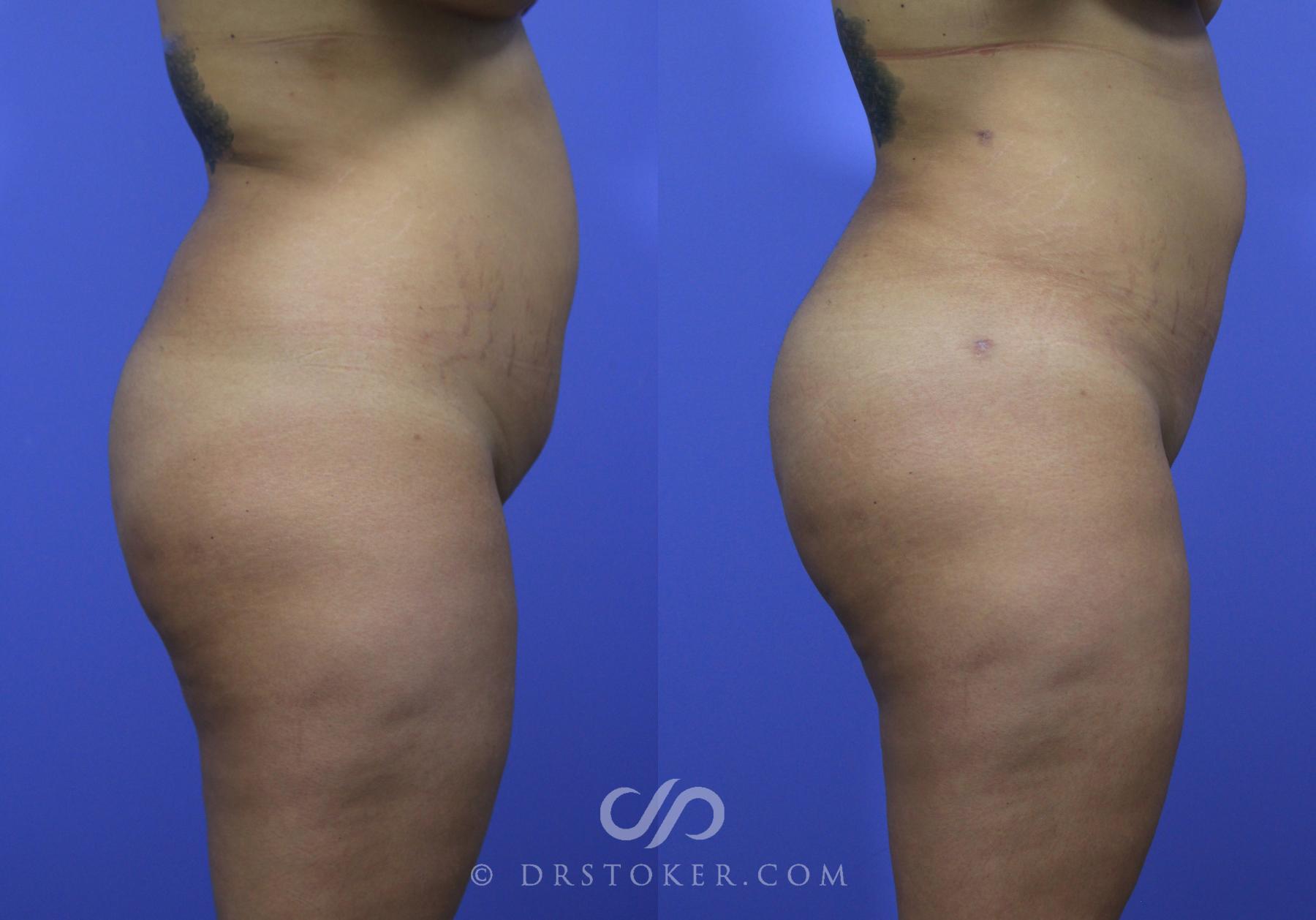 Before & After Brazilian Butt Lift (Fat Grafts to Buttocks) Case 595 View #1 View in Los Angeles, CA