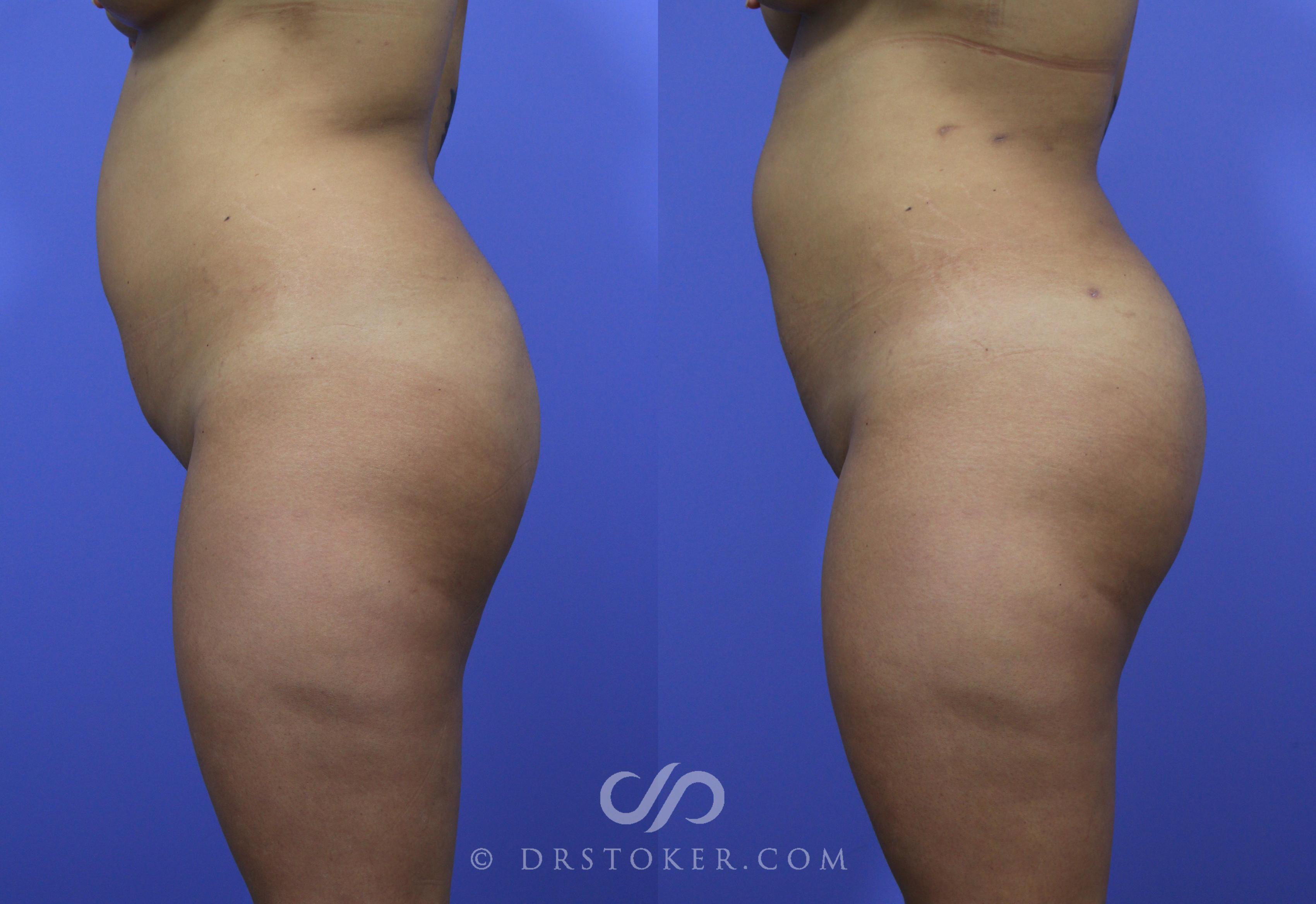 Before & After Brazilian Butt Lift (Fat Grafts to Buttocks) Case 596 View #1 View in Los Angeles, CA