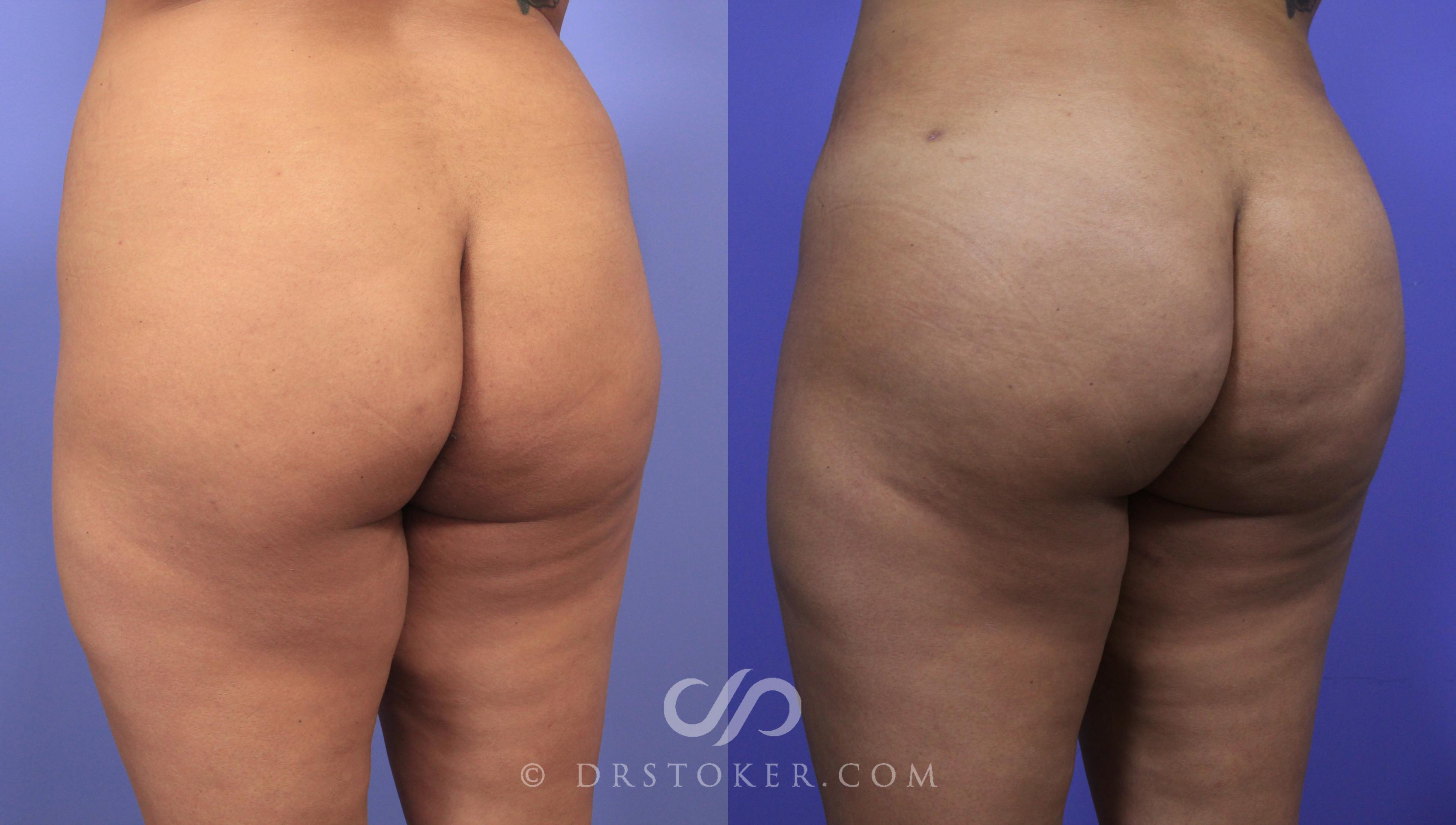Before & After Brazilian Butt Lift (Fat Grafts to Buttocks) Case 597 View #1 View in Los Angeles, CA