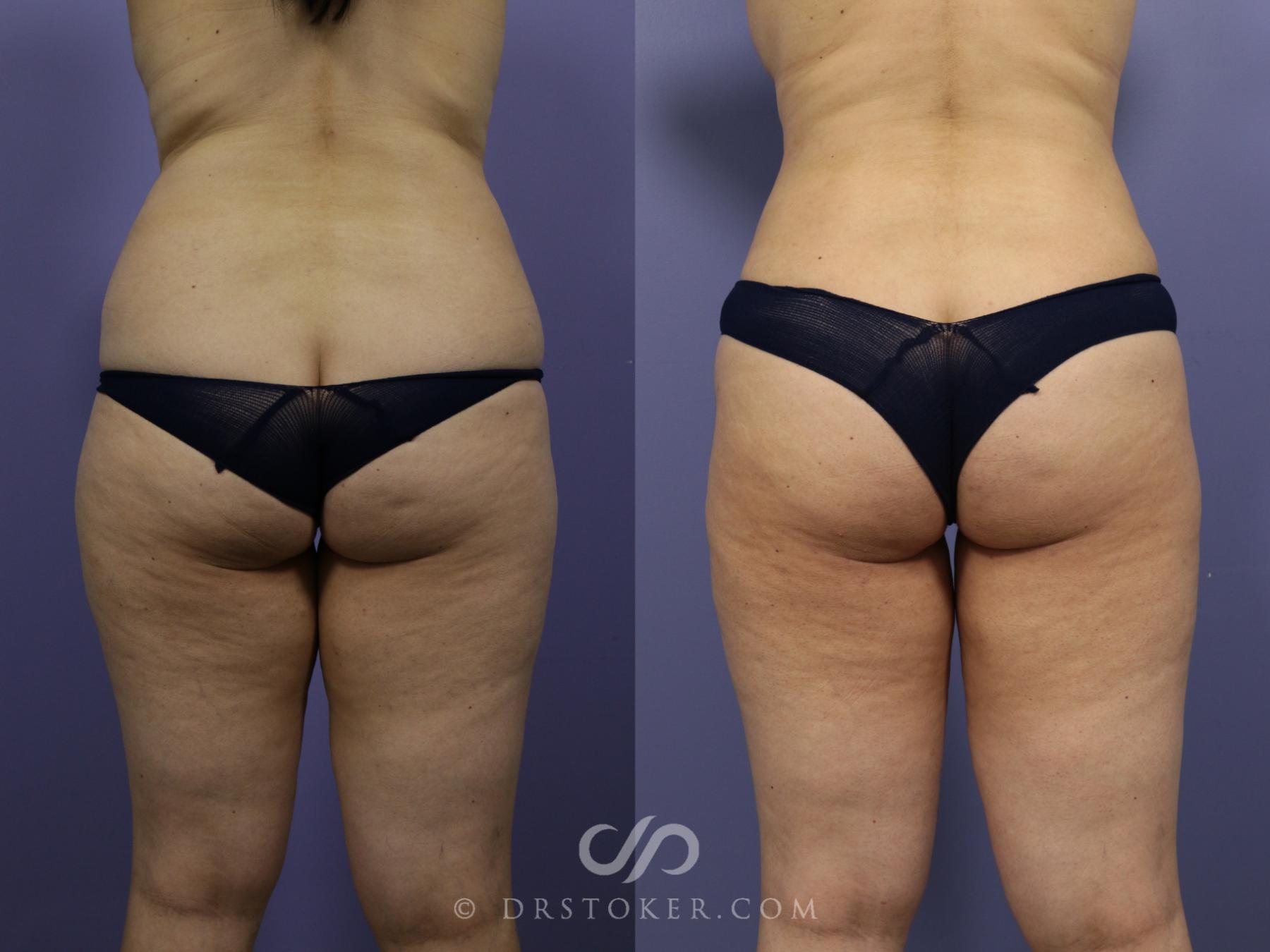 Before & After Brazilian Butt Lift (Fat Grafts to Buttocks) Case 598 View #1 View in Los Angeles, CA