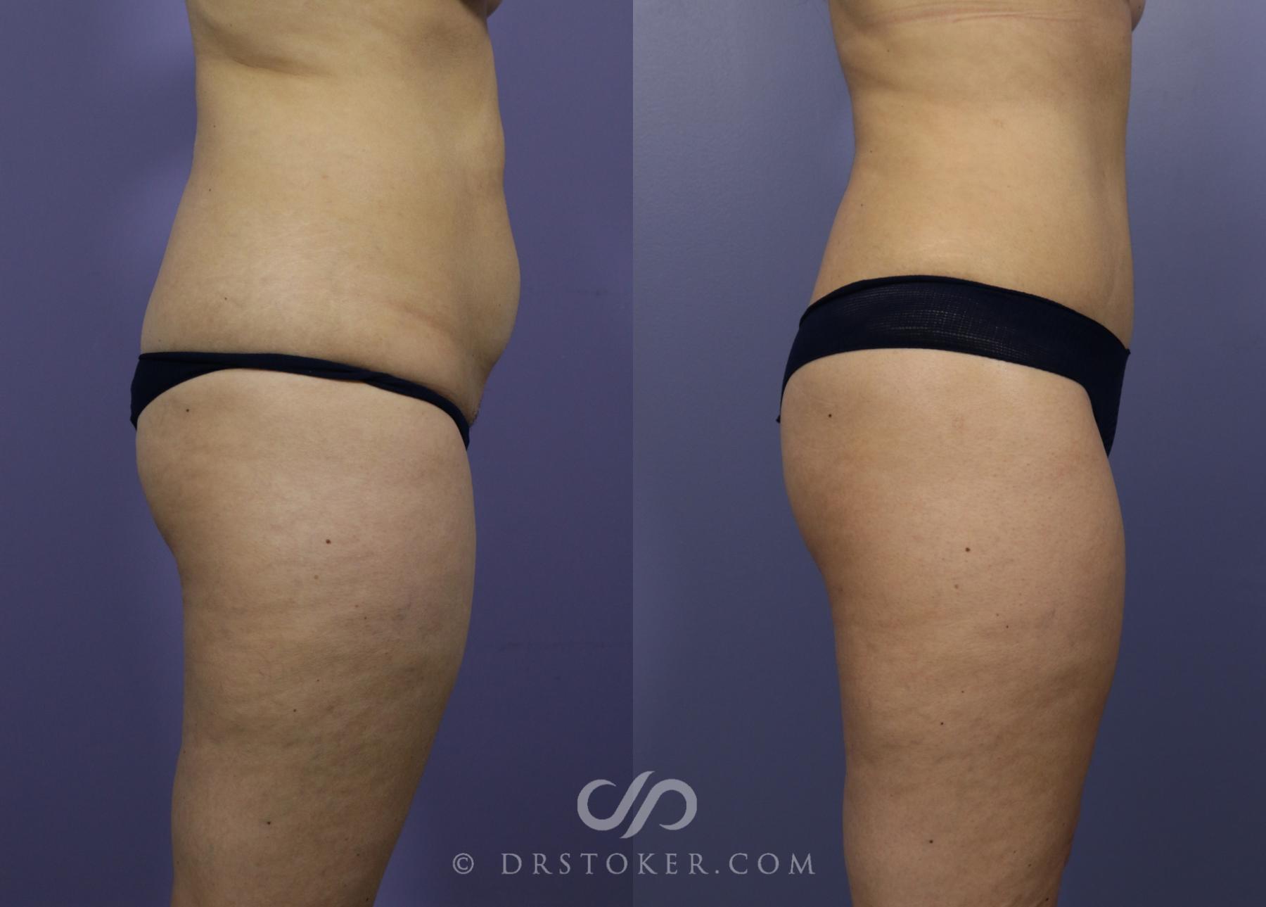 Before & After Brazilian Butt Lift (Fat Grafts to Buttocks) Case 599 View #1 View in Los Angeles, CA