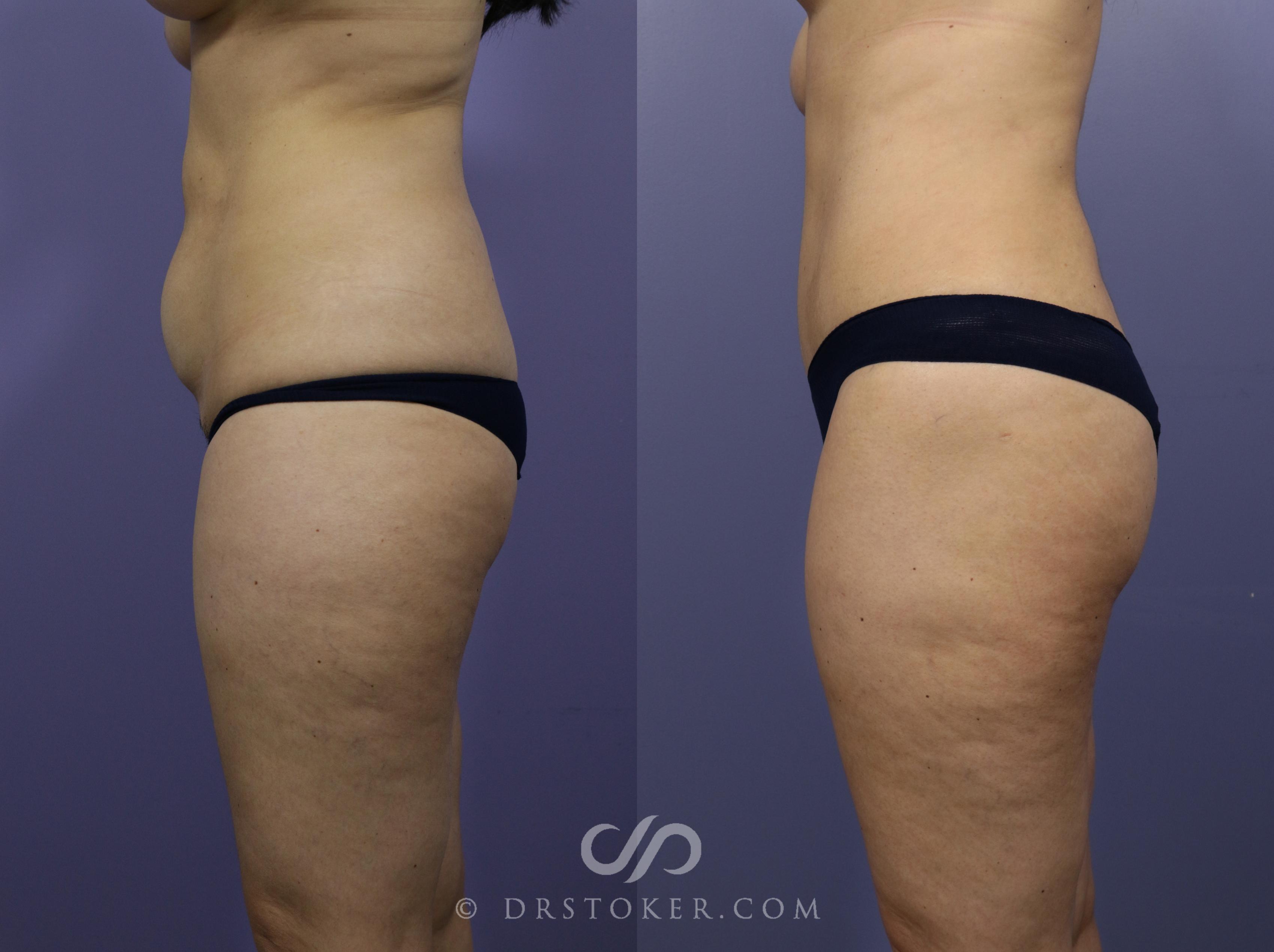 Before & After Brazilian Butt Lift (Fat Grafts to Buttocks) Case 600 View #1 View in Los Angeles, CA