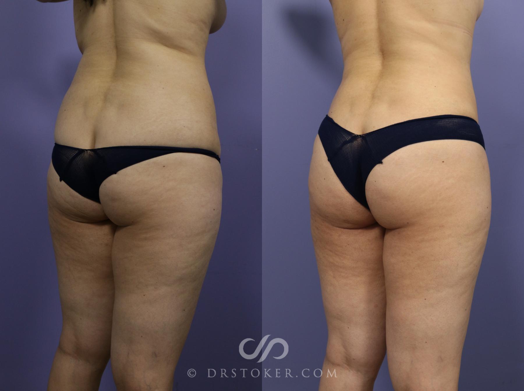 Before & After Brazilian Butt Lift (Fat Grafts to Buttocks) Case 601 View #1 View in Los Angeles, CA