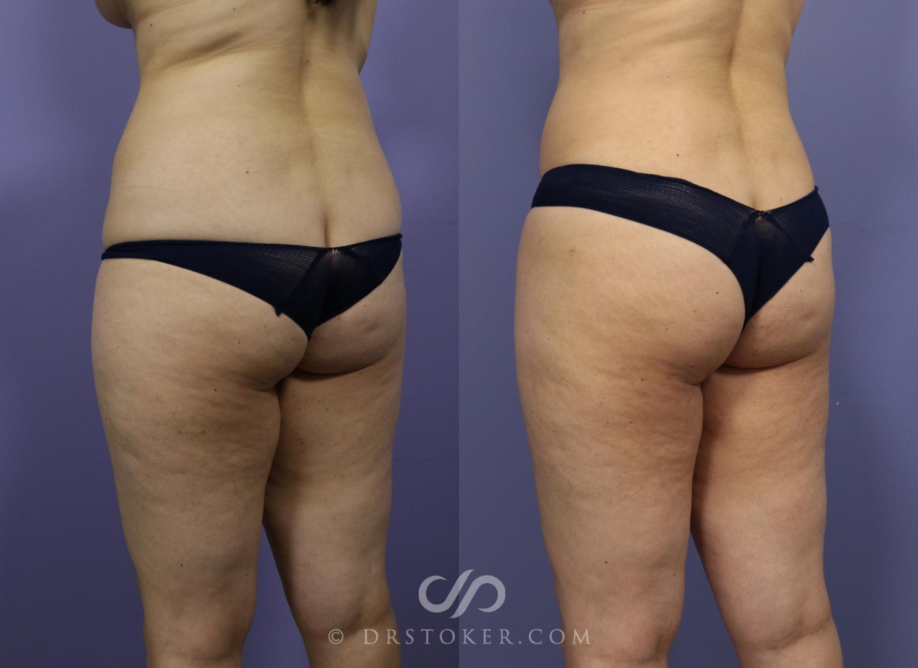 Before & After Brazilian Butt Lift (Fat Grafts to Buttocks) Case 602 View #1 View in Los Angeles, CA