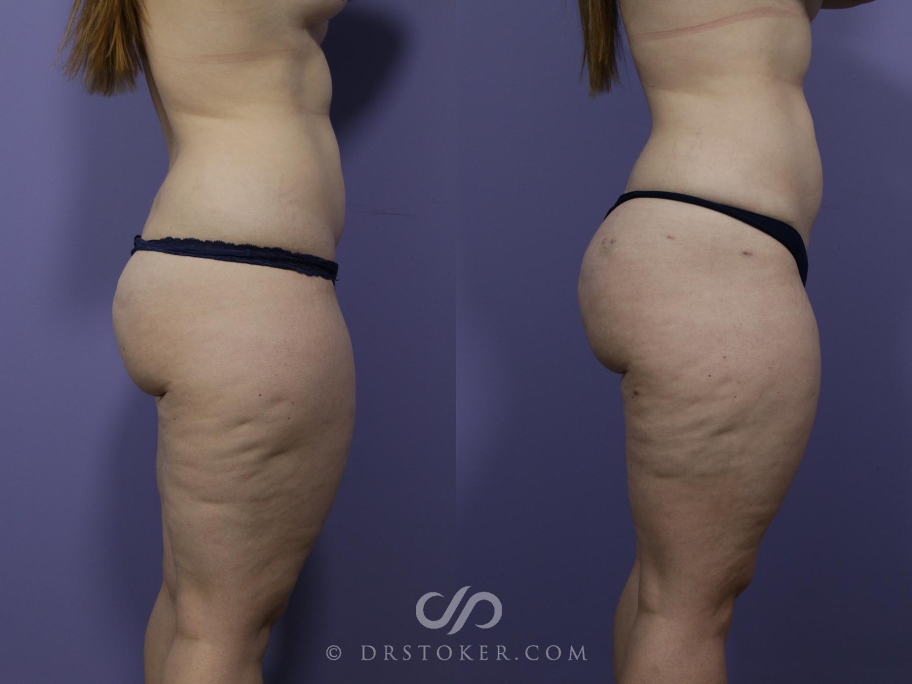 Before & After Brazilian Butt Lift (Fat Grafts to Buttocks) Case 603 View #1 View in Los Angeles, CA