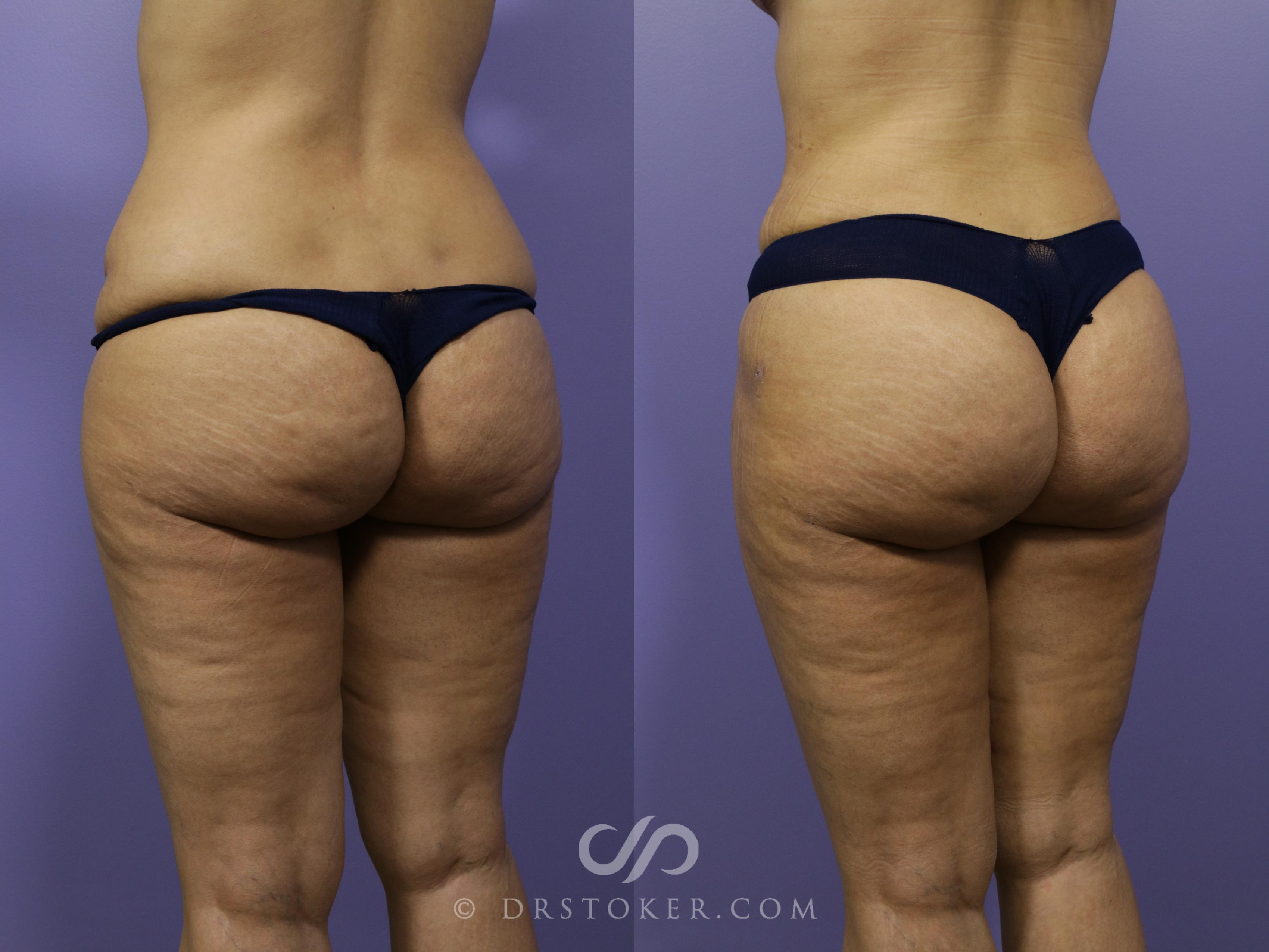 Before & After Brazilian Butt Lift (Fat Grafts to Buttocks) Case 604 View #1 View in Los Angeles, CA