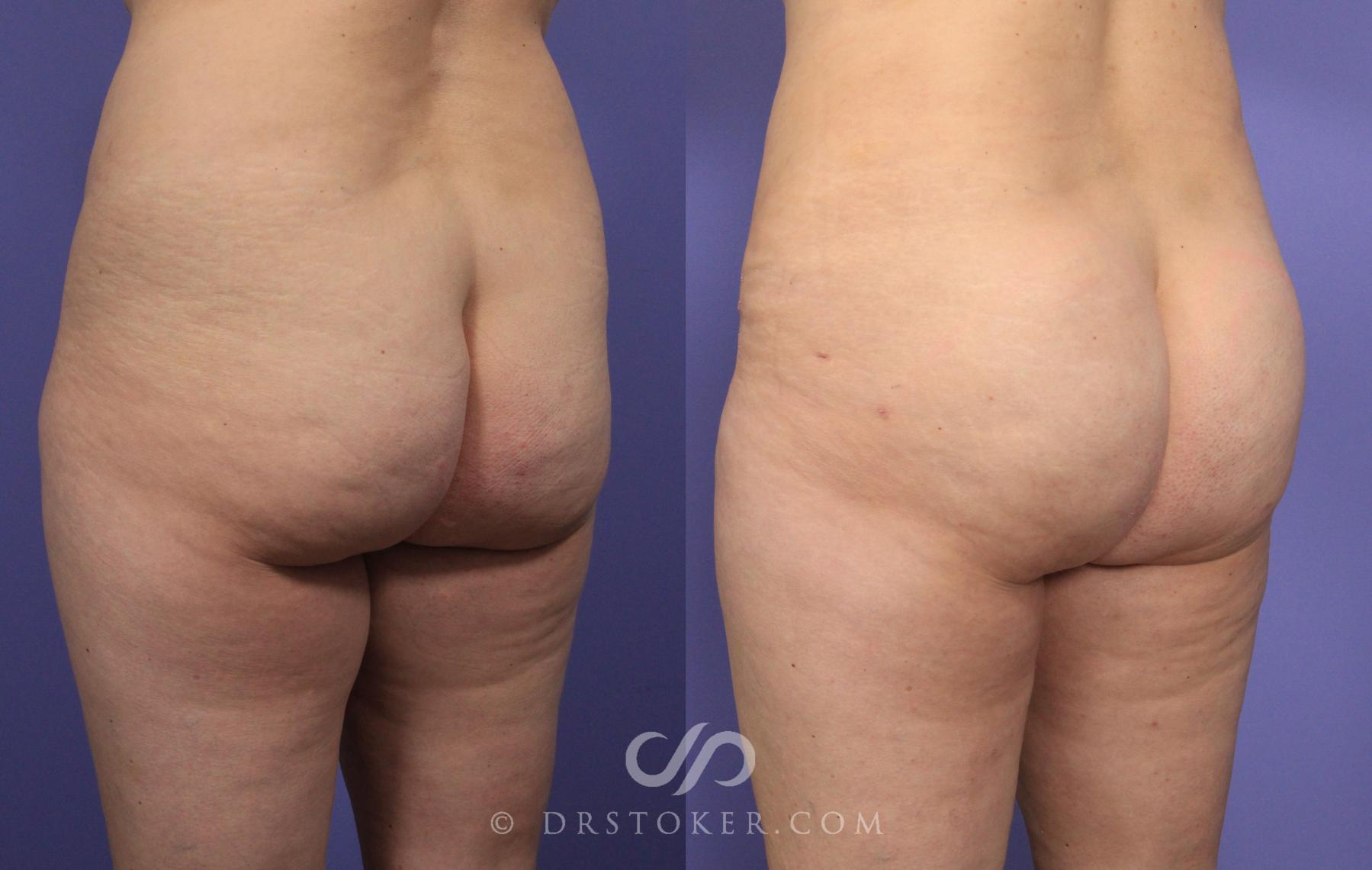 Before & After Brazilian Butt Lift (Fat Grafts to Buttocks) Case 605 View #1 View in Los Angeles, CA