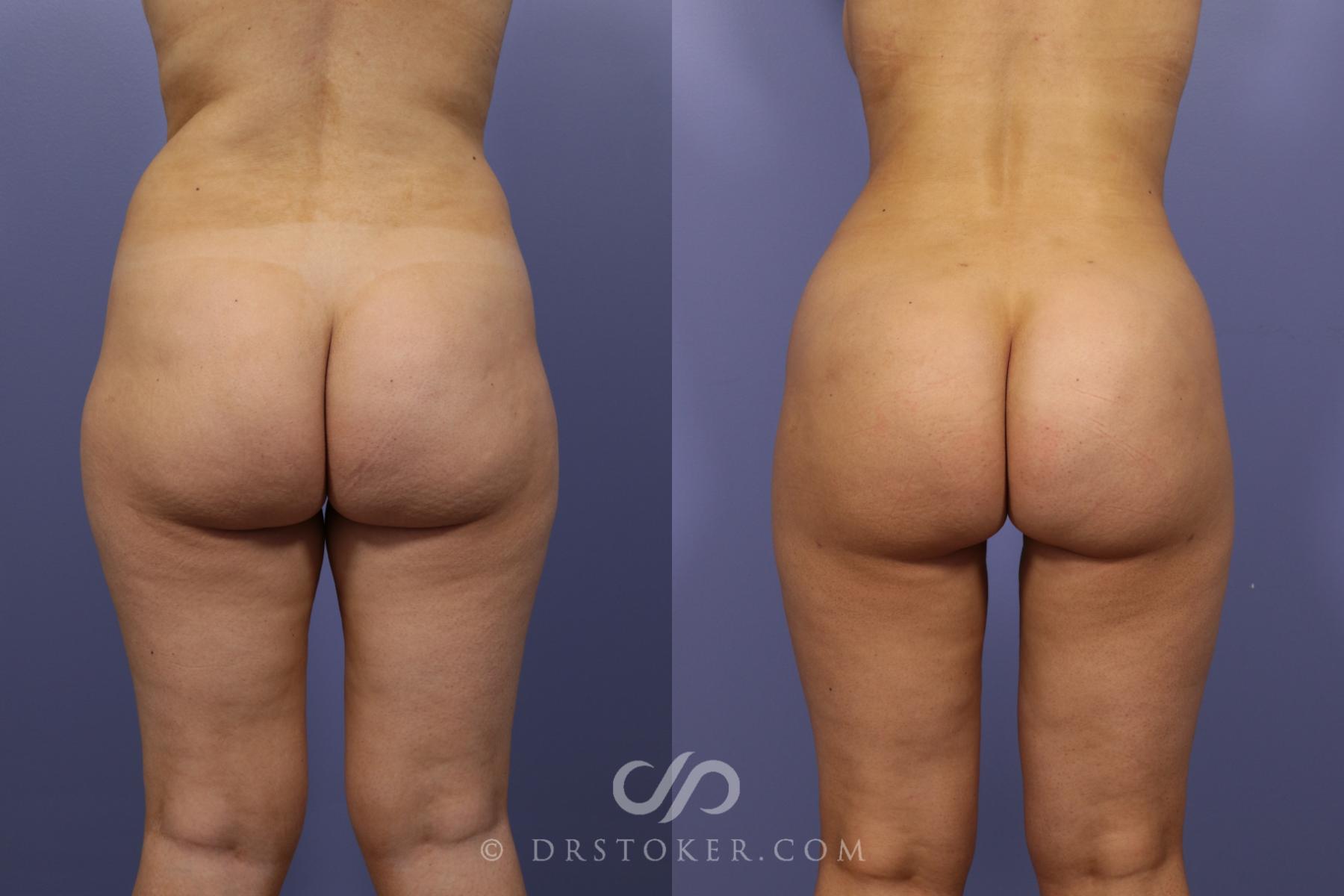 Before & After Brazilian Butt Lift (Fat Grafts to Buttocks) Case 606 View #1 View in Los Angeles, CA