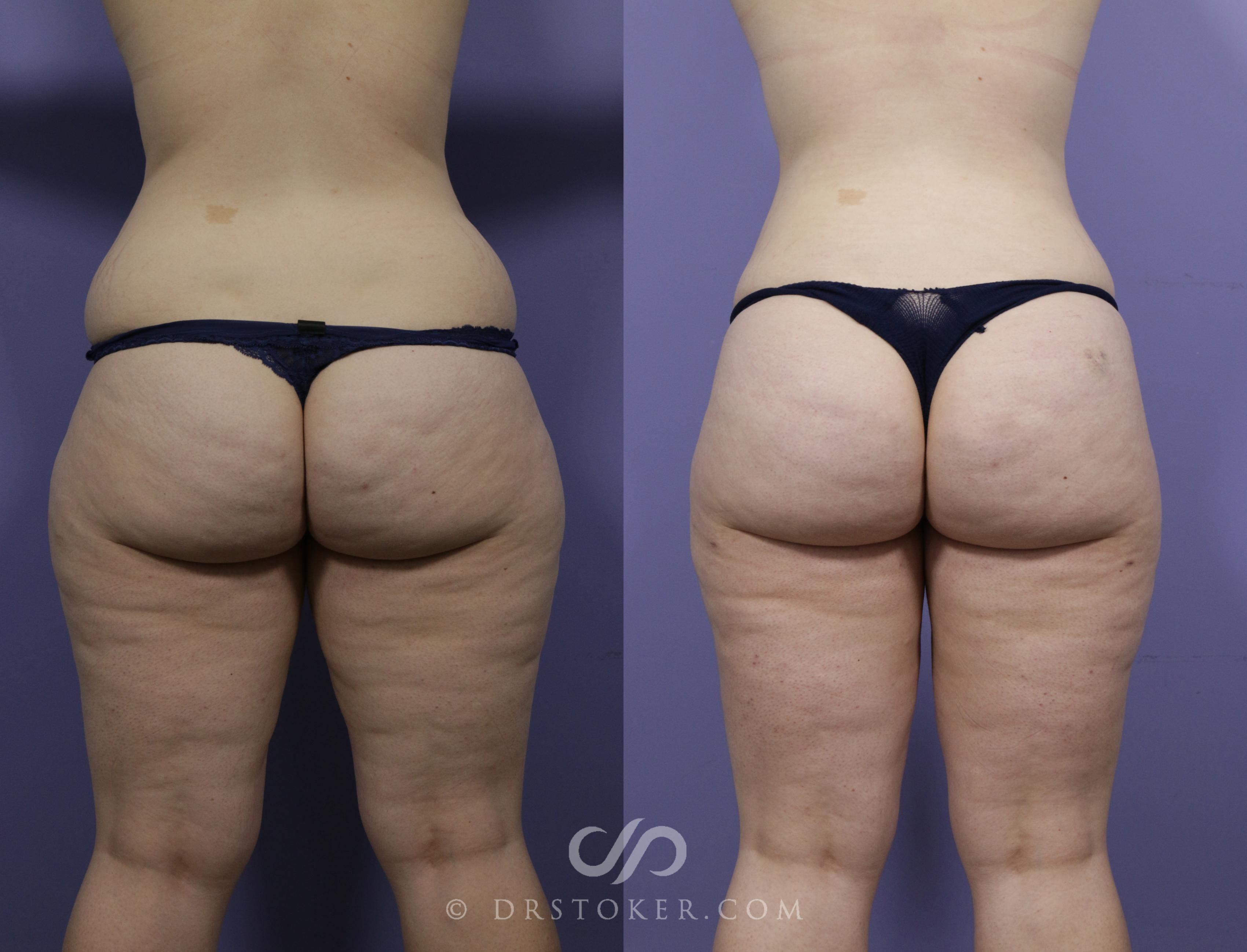 Before & After Brazilian Butt Lift (Fat Grafts to Buttocks) Case 610 View #1 View in Los Angeles, CA