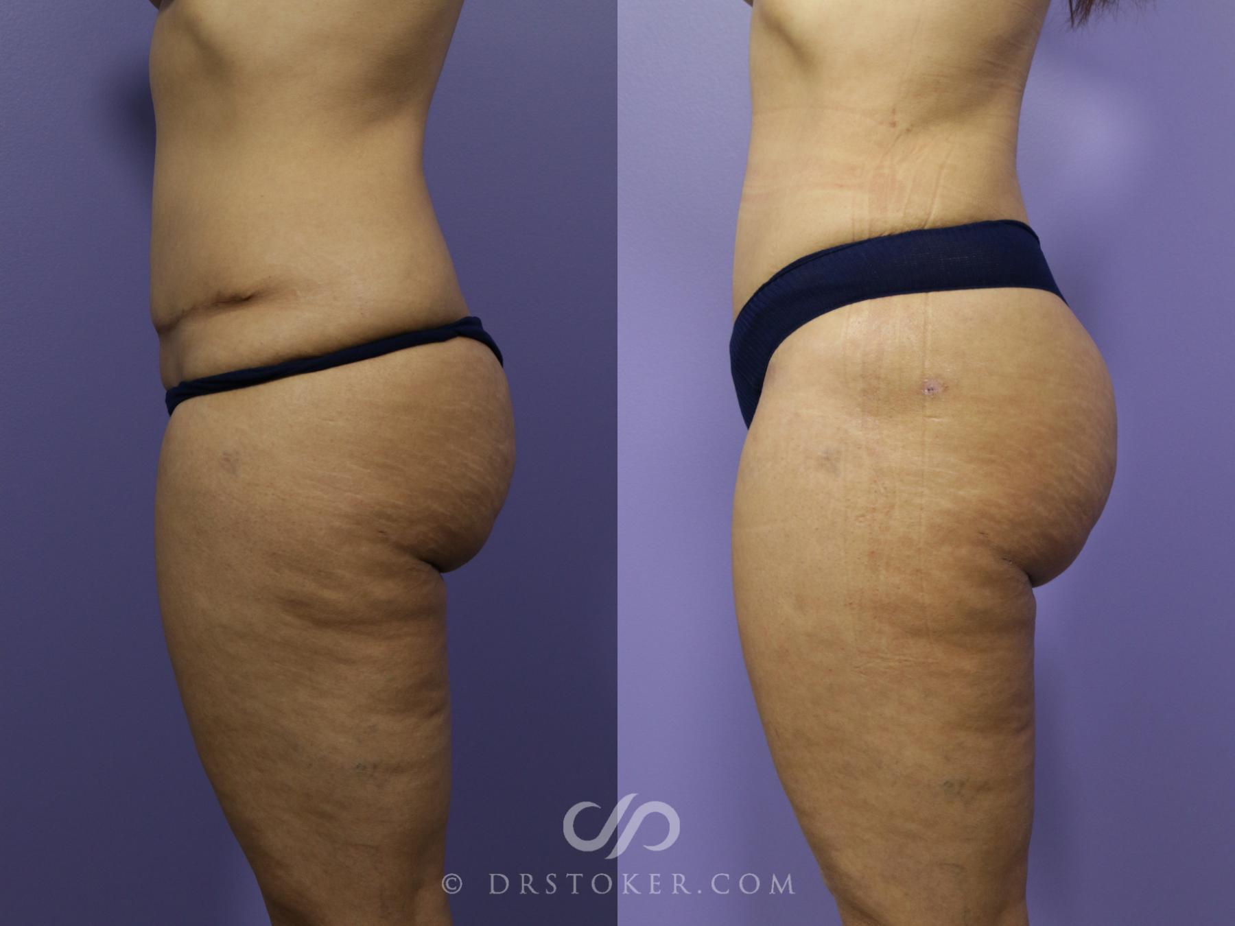 Before & After Brazilian Butt Lift (Fat Grafts to Buttocks) Case 611 View #1 View in Los Angeles, CA
