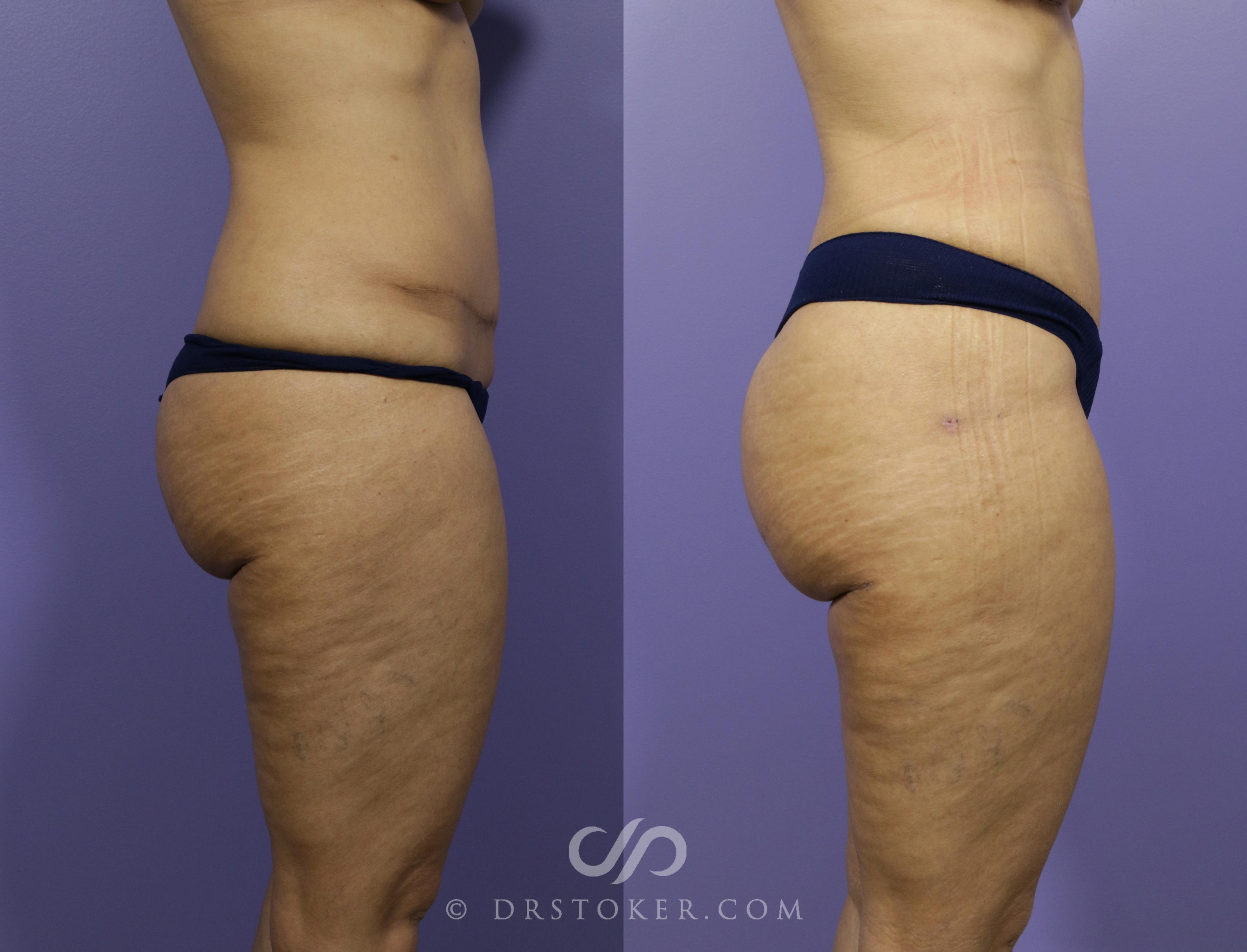Before & After Brazilian Butt Lift (Fat Grafts to Buttocks) Case 612 View #1 View in Los Angeles, CA