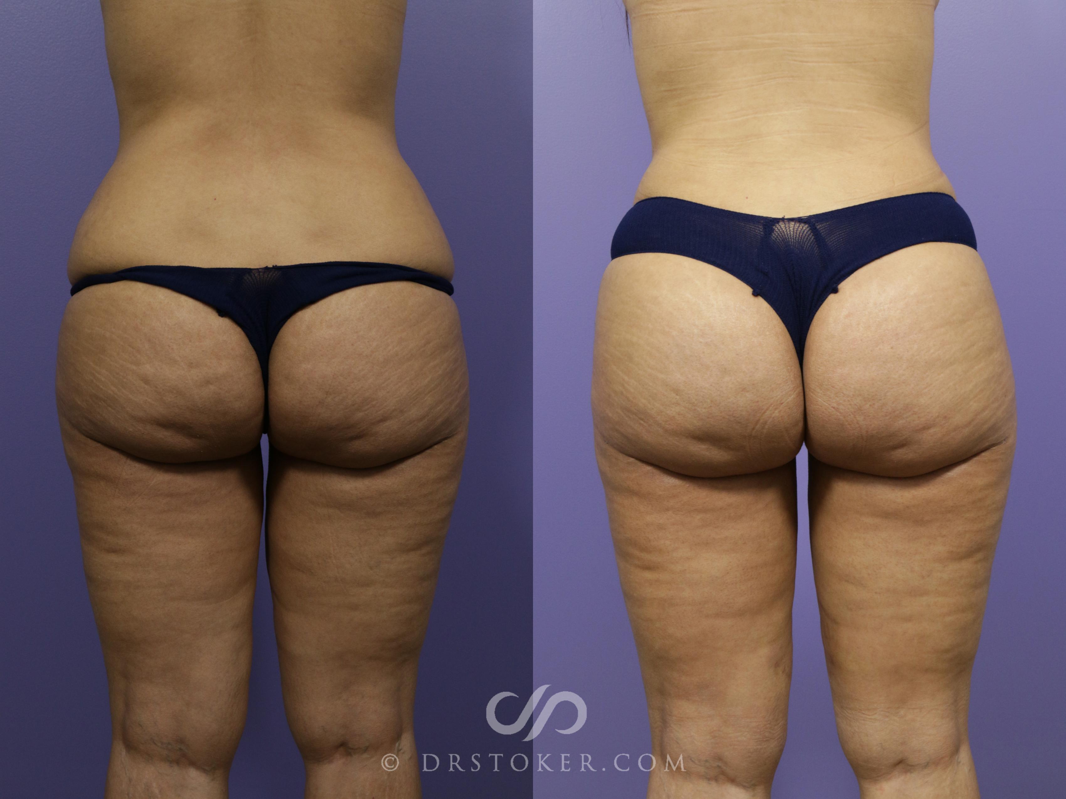 Before & After Brazilian Butt Lift (Fat Grafts to Buttocks) Case 613 View #1 View in Los Angeles, CA