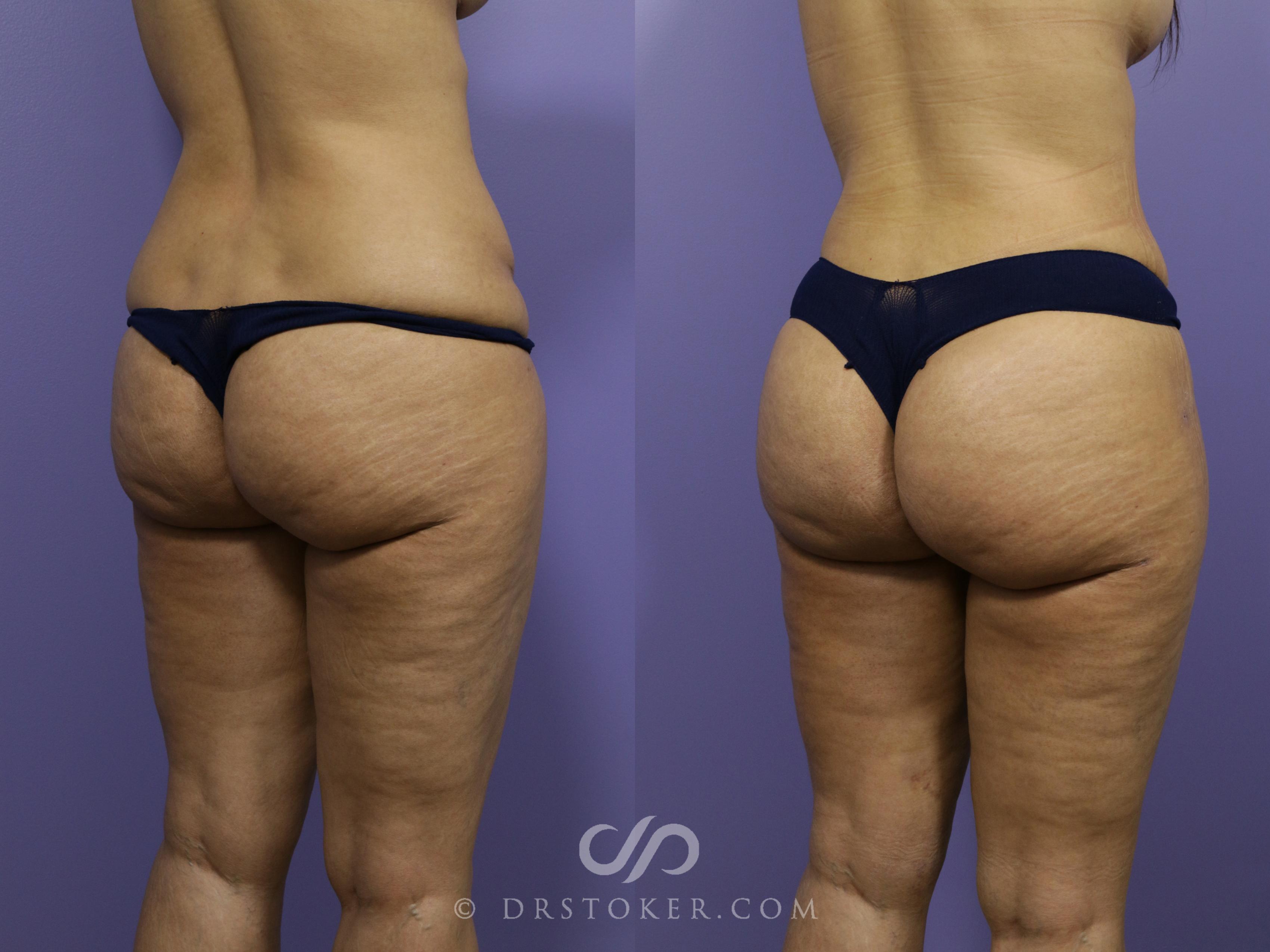 Before & After Brazilian Butt Lift (Fat Grafts to Buttocks) Case 613 View #2 View in Los Angeles, CA