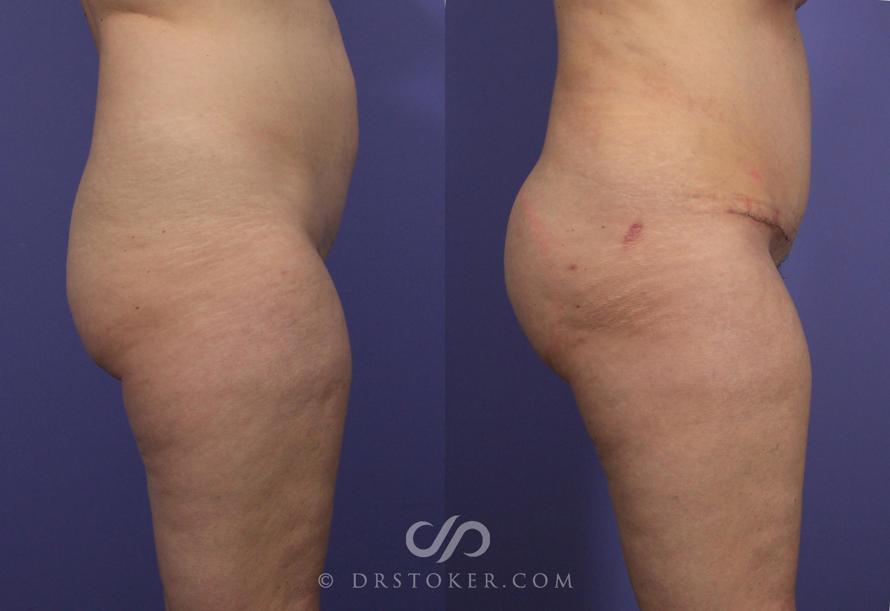 Before & After Brazilian Butt Lift (Fat Grafts to Buttocks) Case 614 View #1 View in Los Angeles, CA