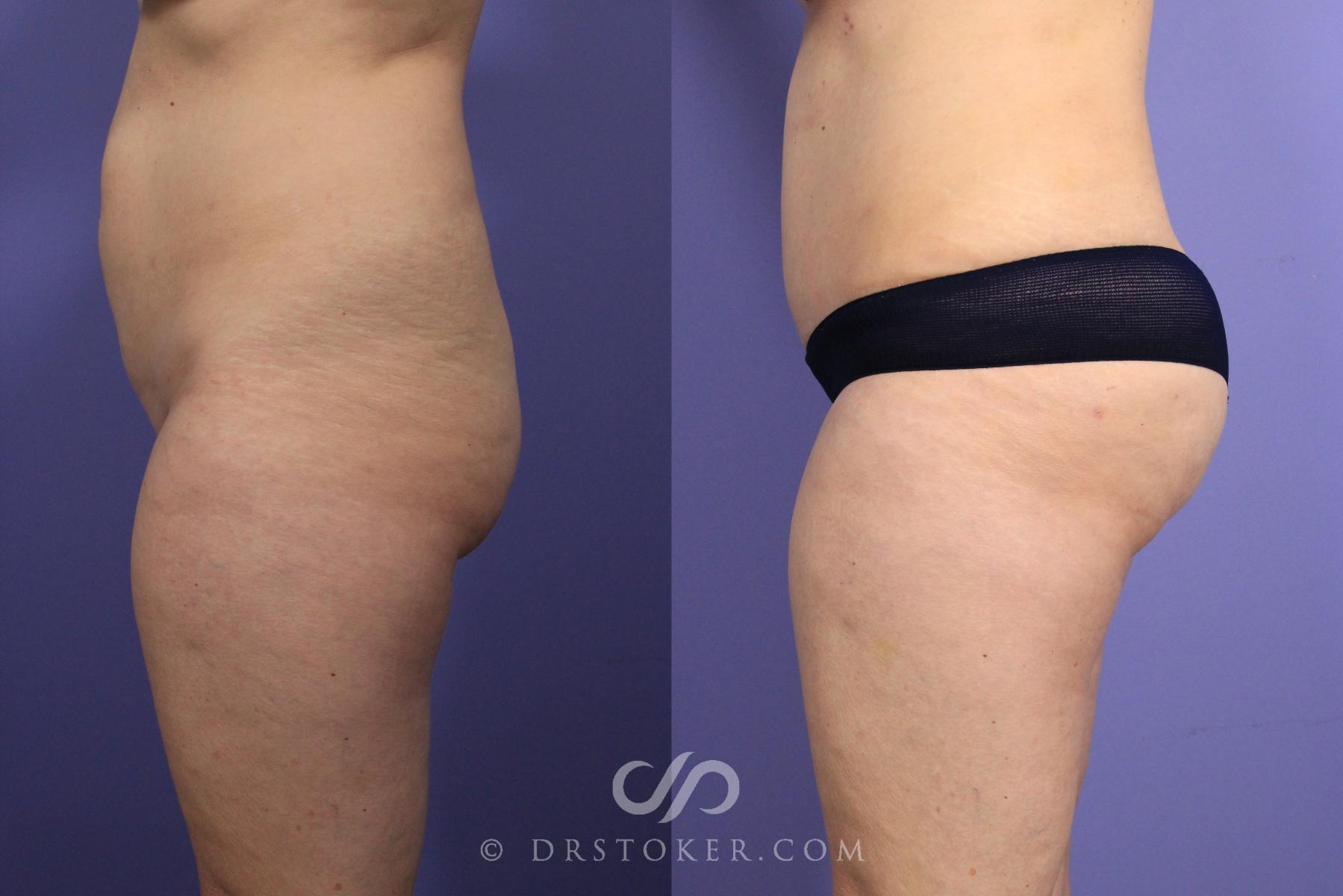 Before & After Brazilian Butt Lift (Fat Grafts to Buttocks) Case 616 View #1 View in Los Angeles, CA