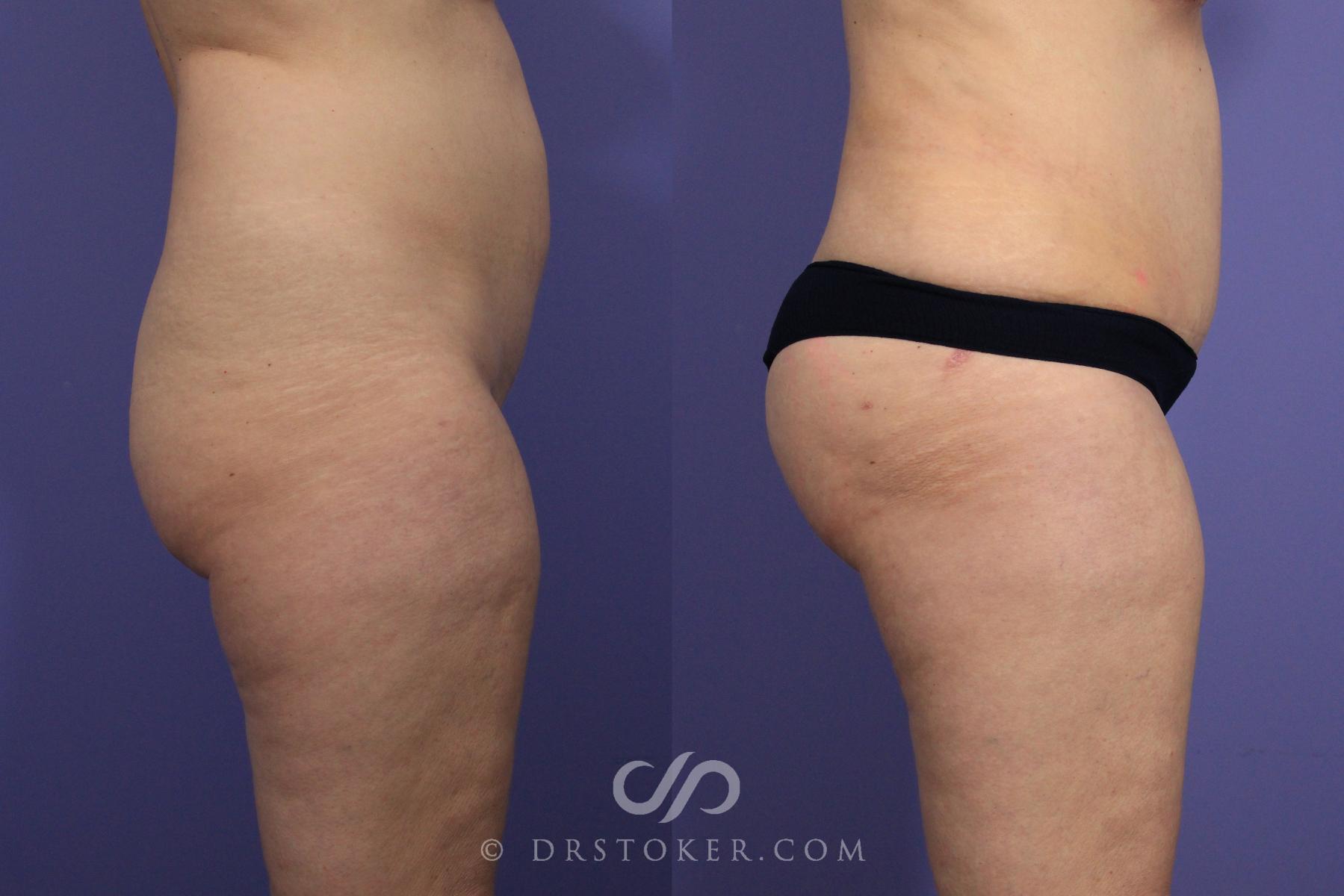 Before & After Brazilian Butt Lift (Fat Grafts to Buttocks) Case 617 View #1 View in Los Angeles, CA