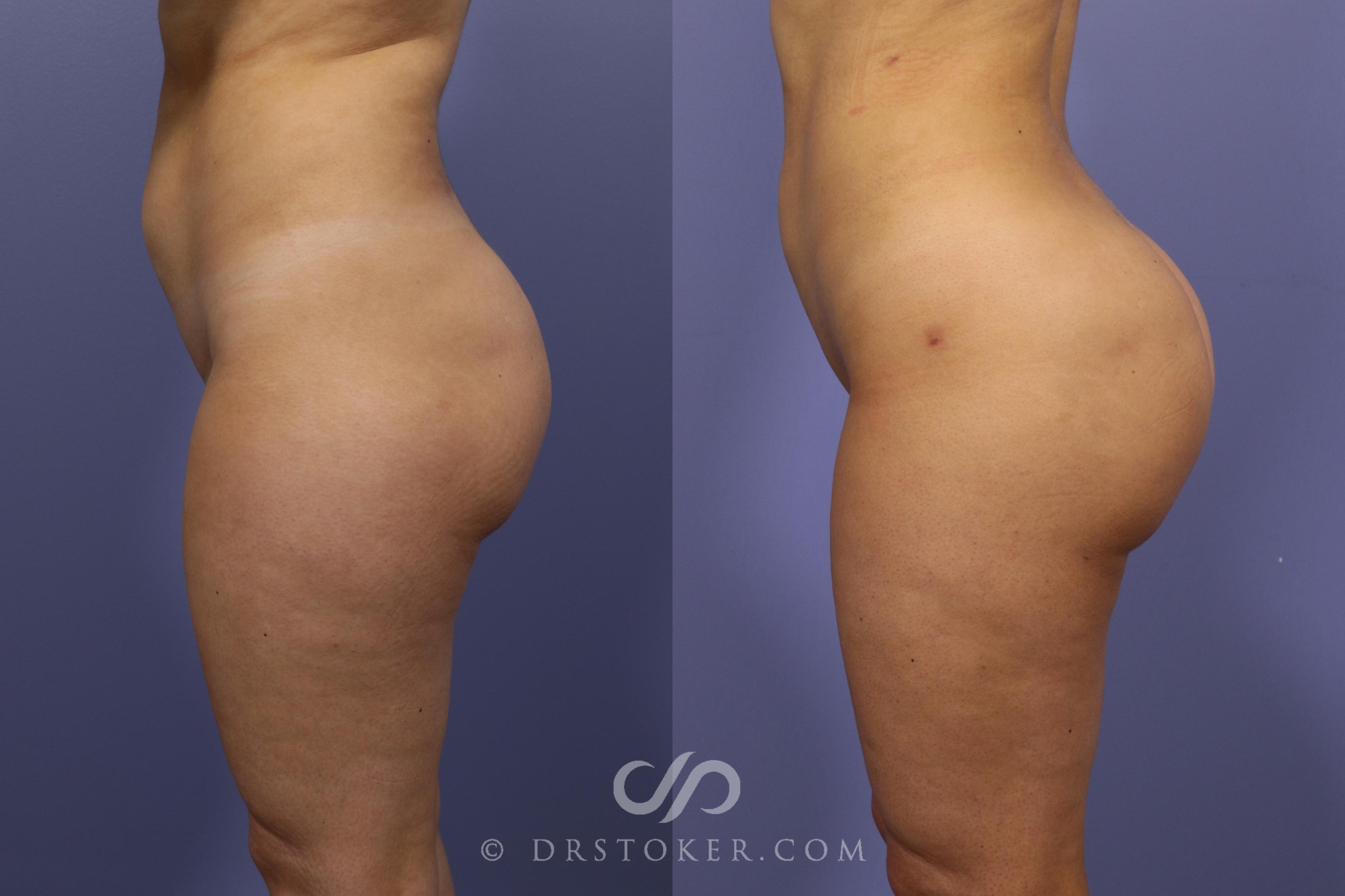 Before & After Brazilian Butt Lift (Fat Grafts to Buttocks) Case 621 View #1 View in Los Angeles, CA
