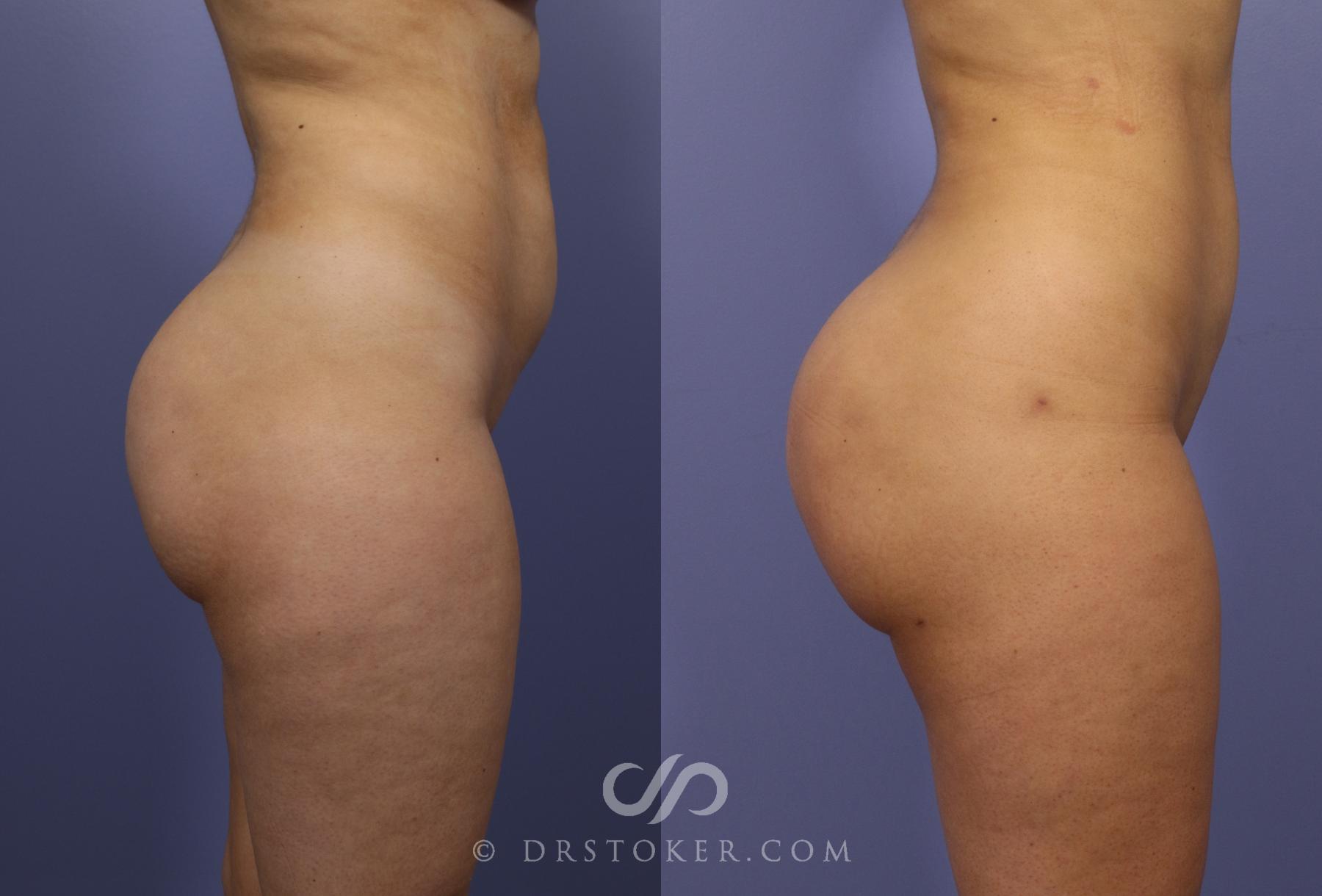 Before & After Brazilian Butt Lift (Fat Grafts to Buttocks) Case 622 View #1 View in Los Angeles, CA