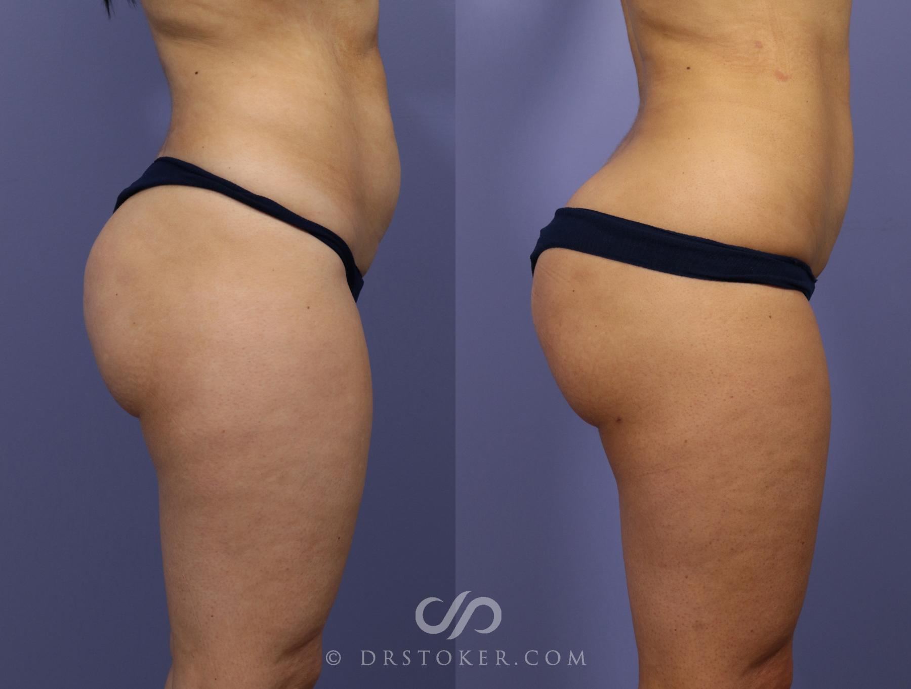 Before & After Brazilian Butt Lift (Fat Grafts to Buttocks) Case 624 View #1 View in Los Angeles, CA
