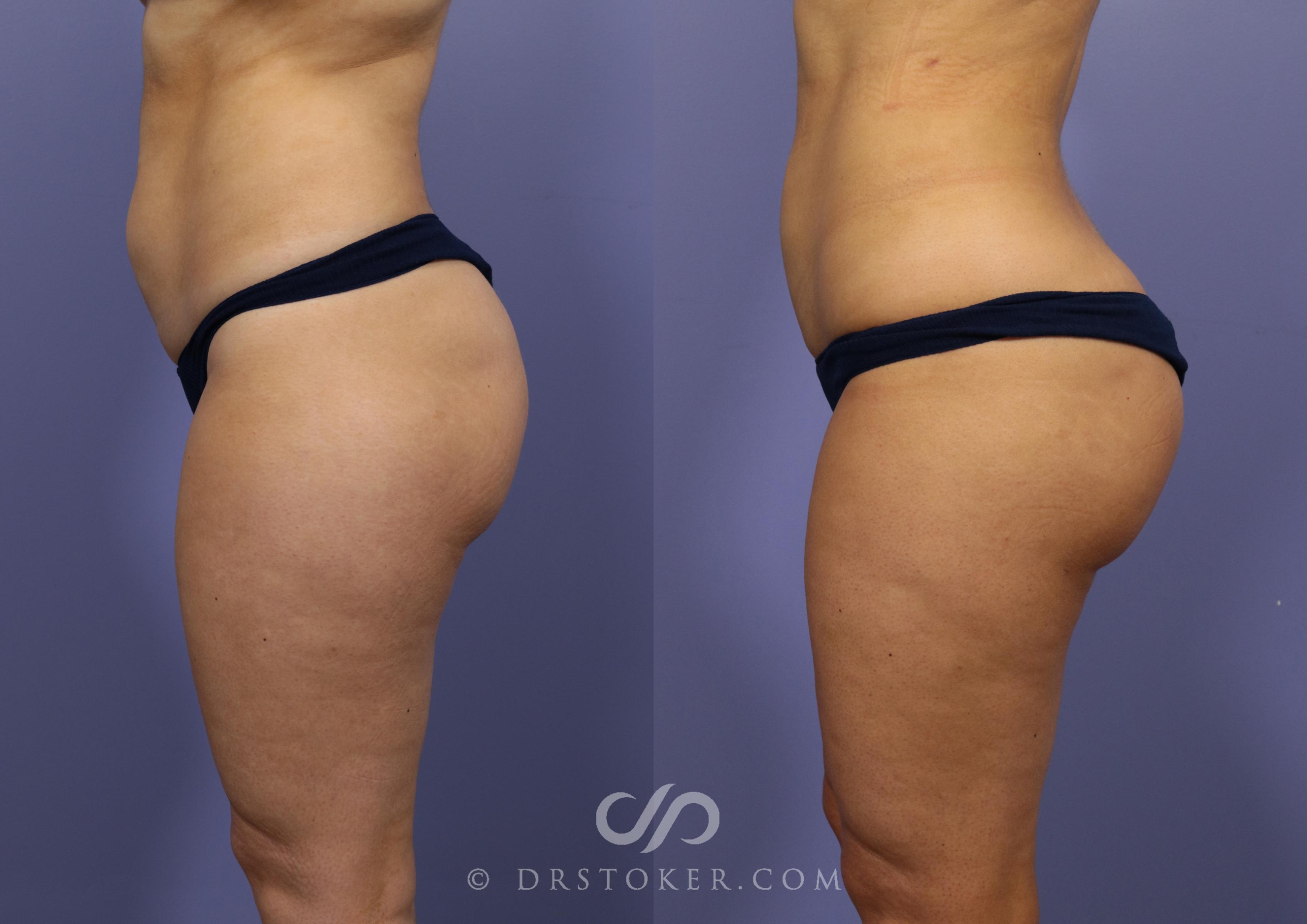 Before & After Brazilian Butt Lift (Fat Grafts to Buttocks) Case 625 View #1 View in Los Angeles, CA
