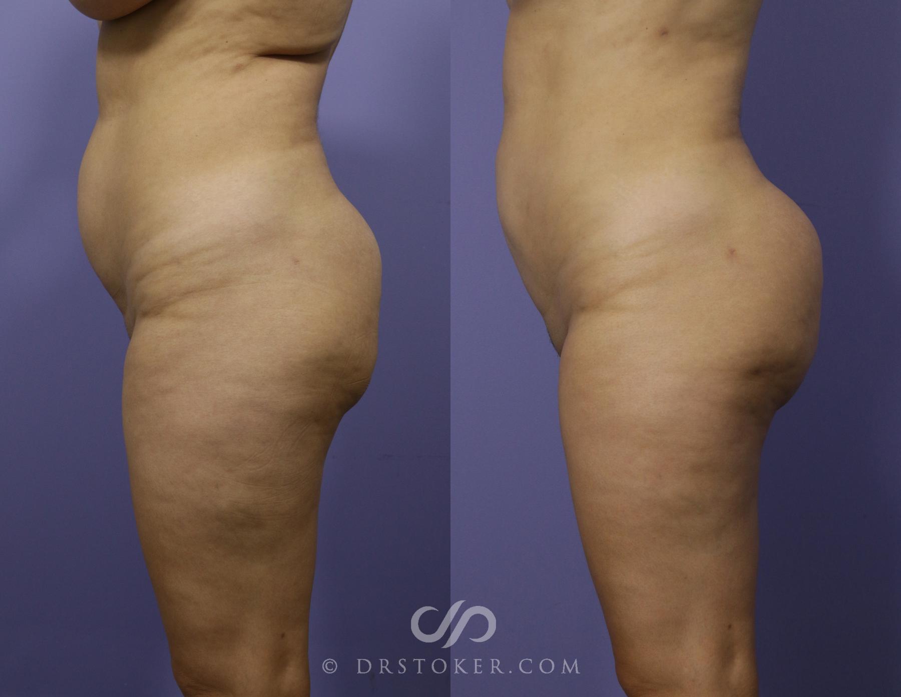 Before & After Brazilian Butt Lift (Fat Grafts to Buttocks) Case 626 View #1 View in Los Angeles, CA