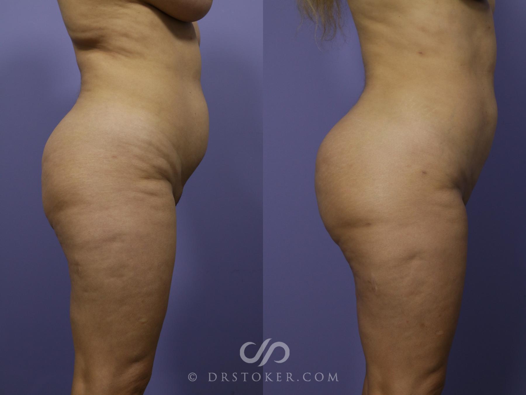 Before & After Brazilian Butt Lift (Fat Grafts to Buttocks) Case 627 View #1 View in Los Angeles, CA