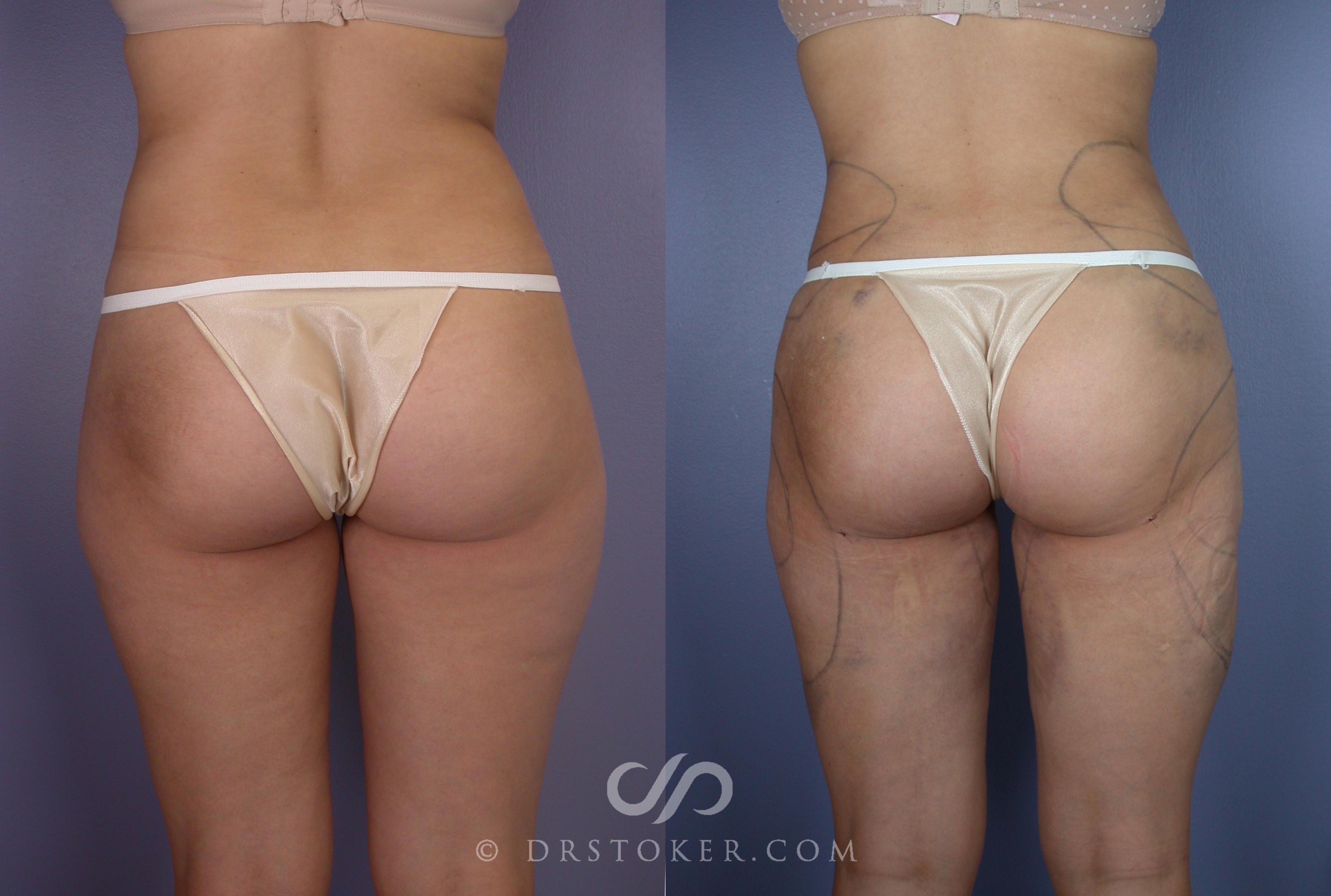 Before & After Brazilian Butt Lift (Fat Grafts to Buttocks) Case 628 View #1 View in Los Angeles, CA