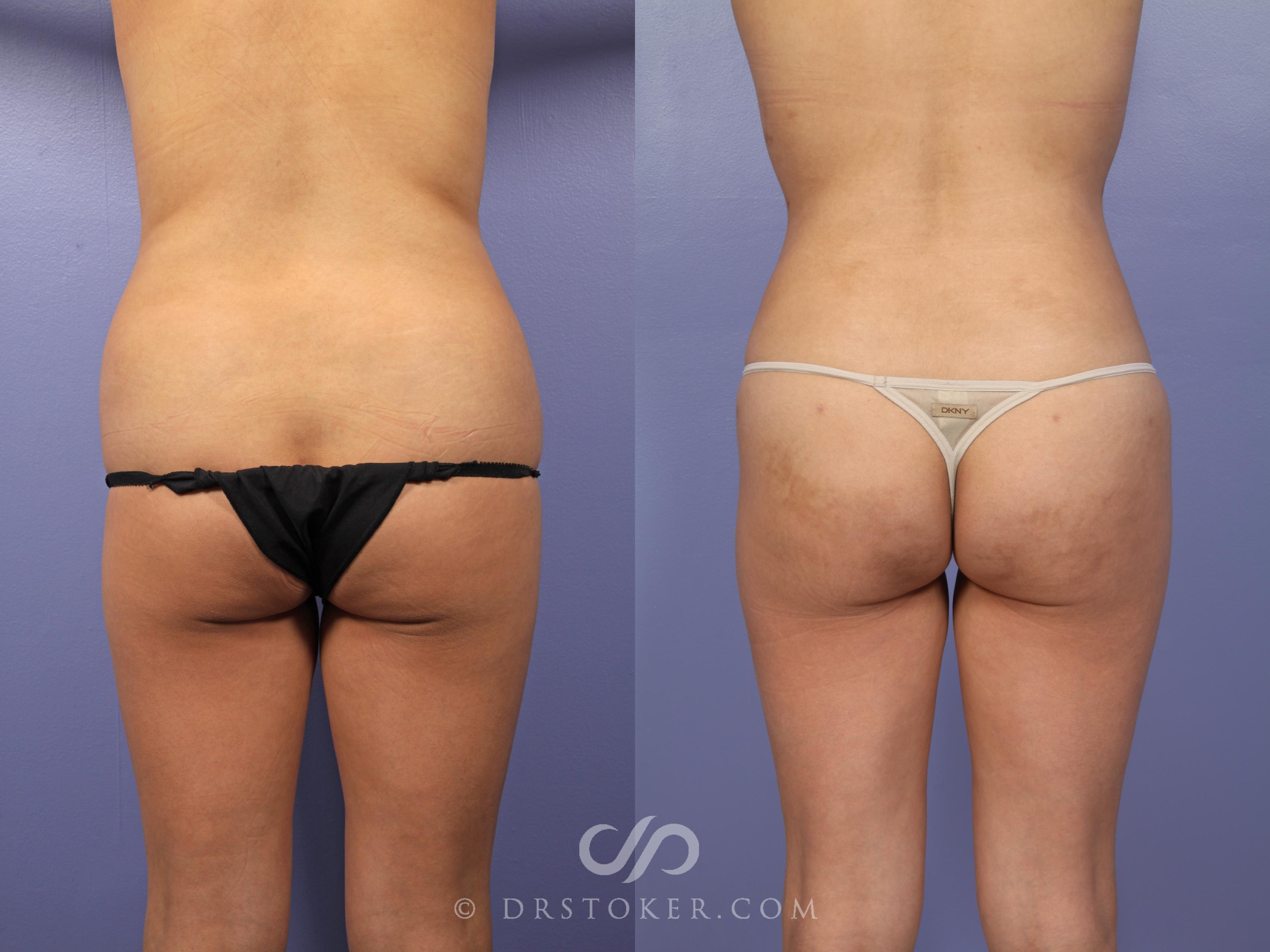 Before & After Brazilian Butt Lift (Fat Grafts to Buttocks) Case 629 View #1 View in Los Angeles, CA