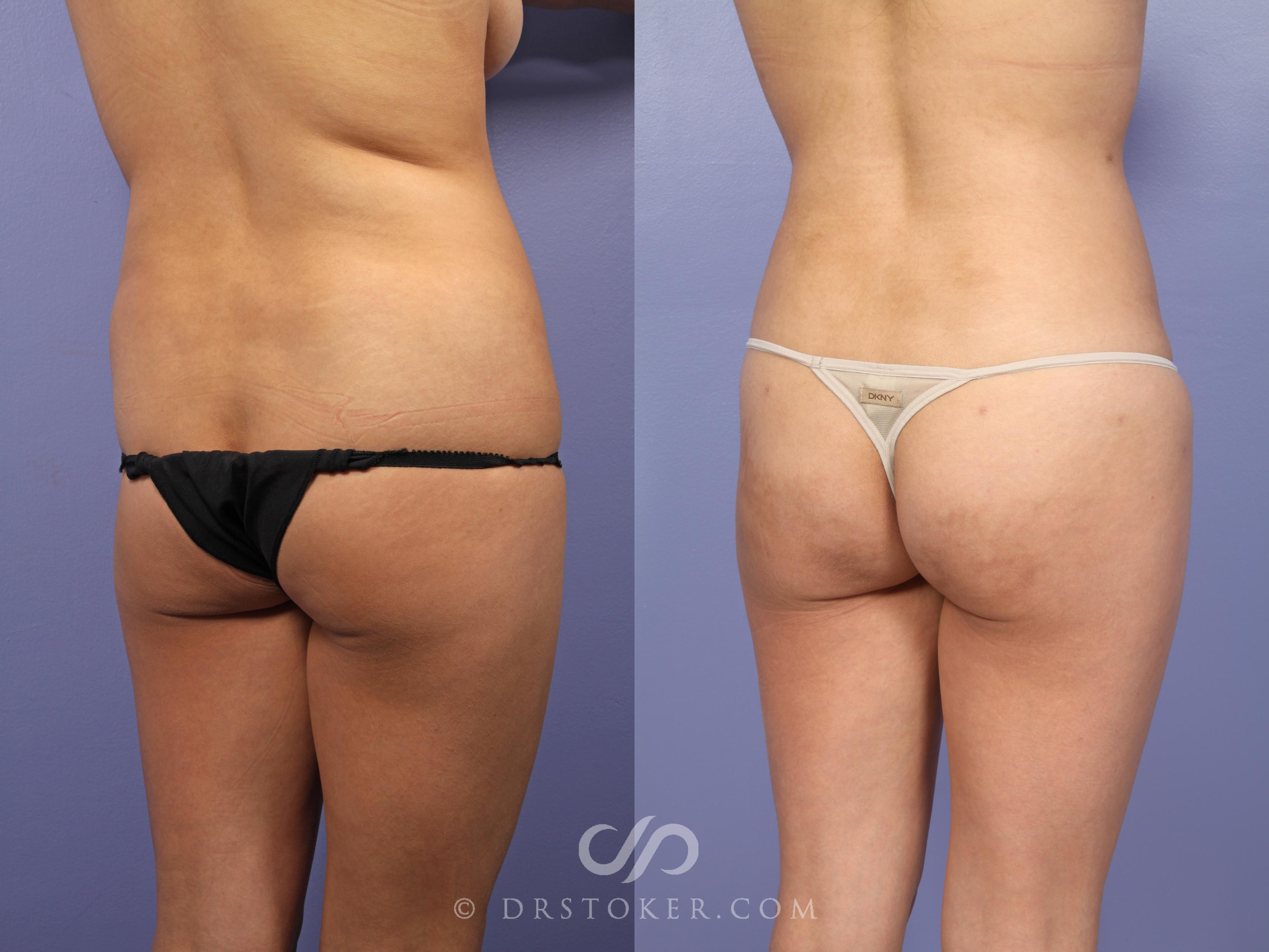 Before & After Brazilian Butt Lift (Fat Grafts to Buttocks) Case 631 View #1 View in Los Angeles, CA