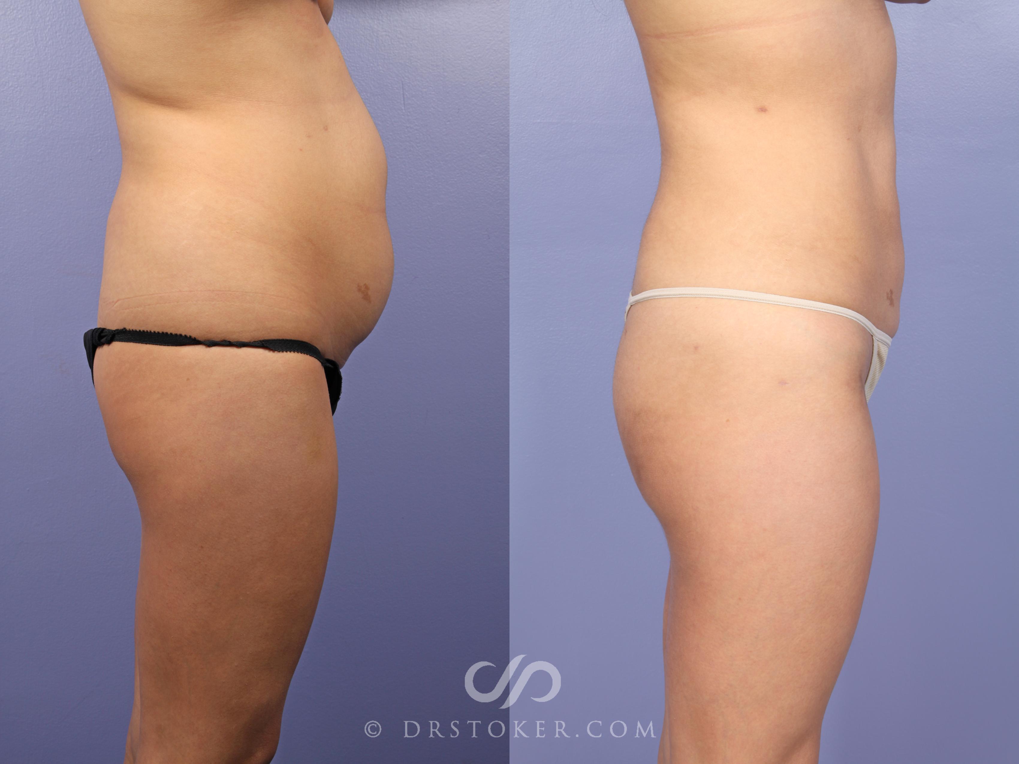 Before & After Brazilian Butt Lift (Fat Grafts to Buttocks) Case 632 View #1 View in Los Angeles, CA