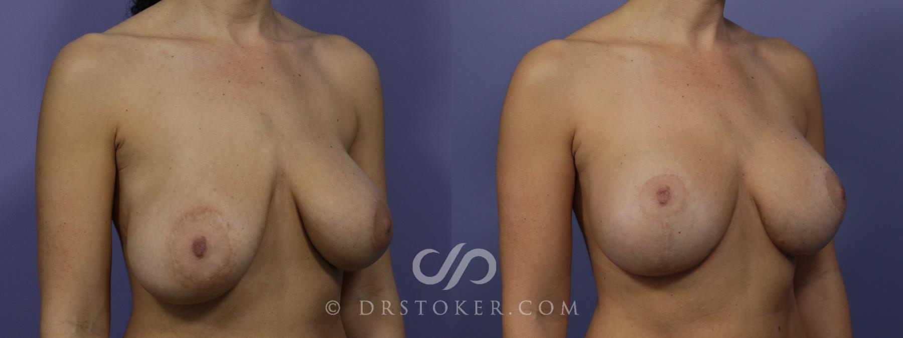 Before & After Breast Asymmetry Correction Case 1232 View #2 View in Los Angeles, CA