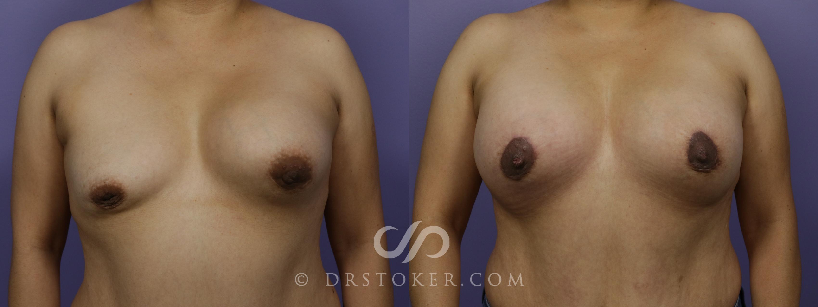 Before & After Breast Asymmetry Correction Case 1267 View #1 View in Los Angeles, CA