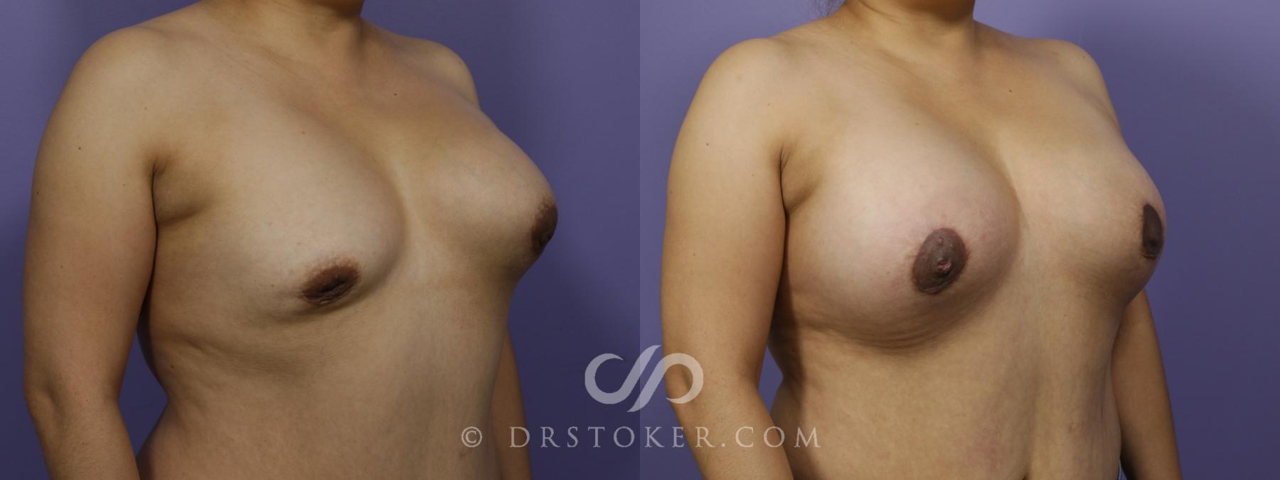 Before & After Breast Asymmetry Correction Case 1267 View #2 View in Los Angeles, CA