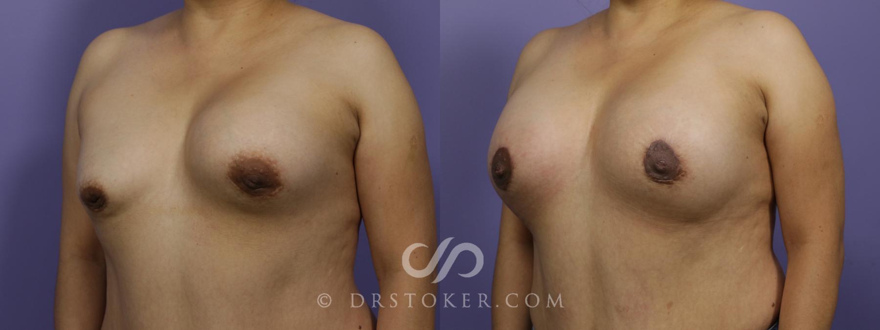 Before & After Breast Asymmetry Correction Case 1267 View #4 View in Los Angeles, CA