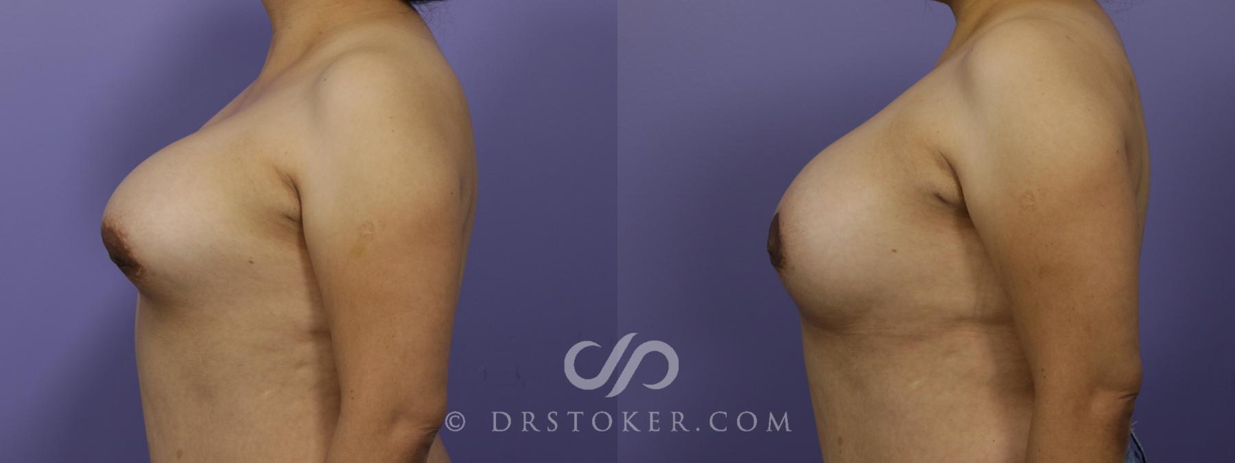 Before & After Breast Asymmetry Correction Case 1267 View #5 View in Los Angeles, CA