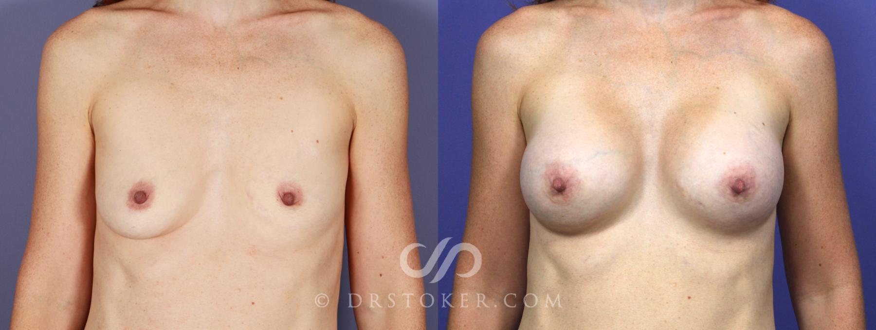 Before & After Breast Asymmetry Correction Case 1268 View #1 View in Los Angeles, CA