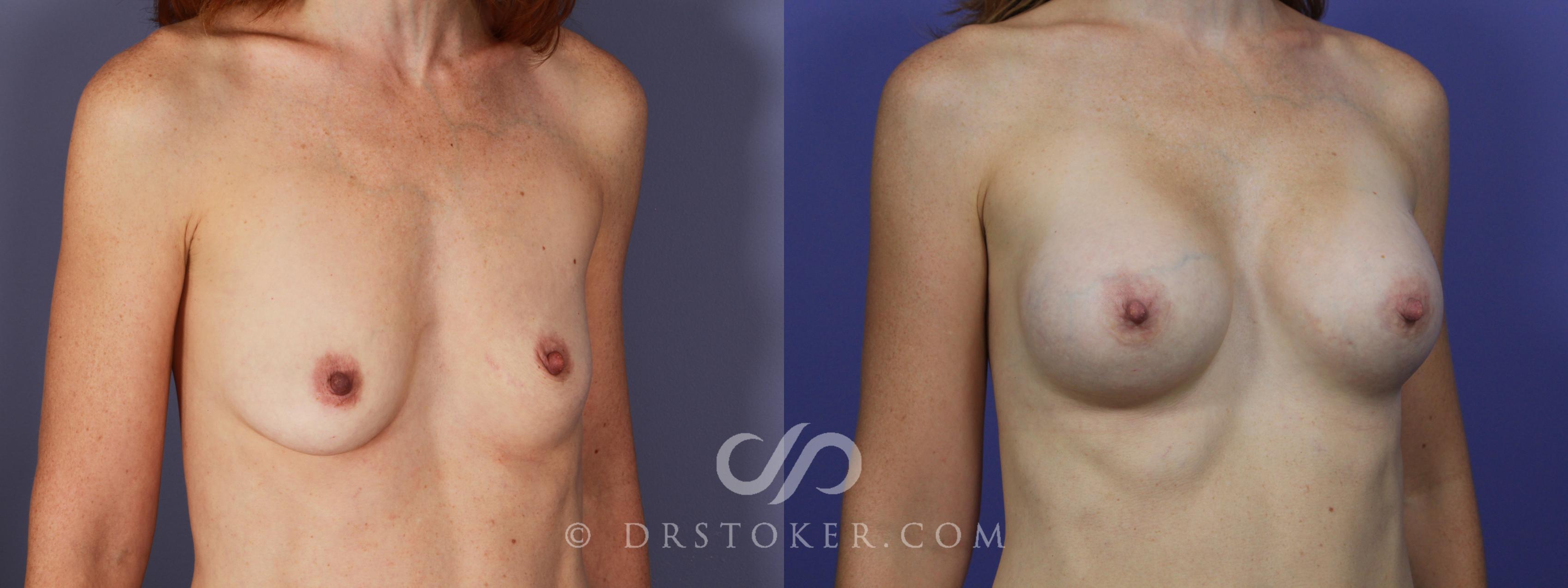 Before & After Breast Asymmetry Correction Case 1268 View #2 View in Los Angeles, CA