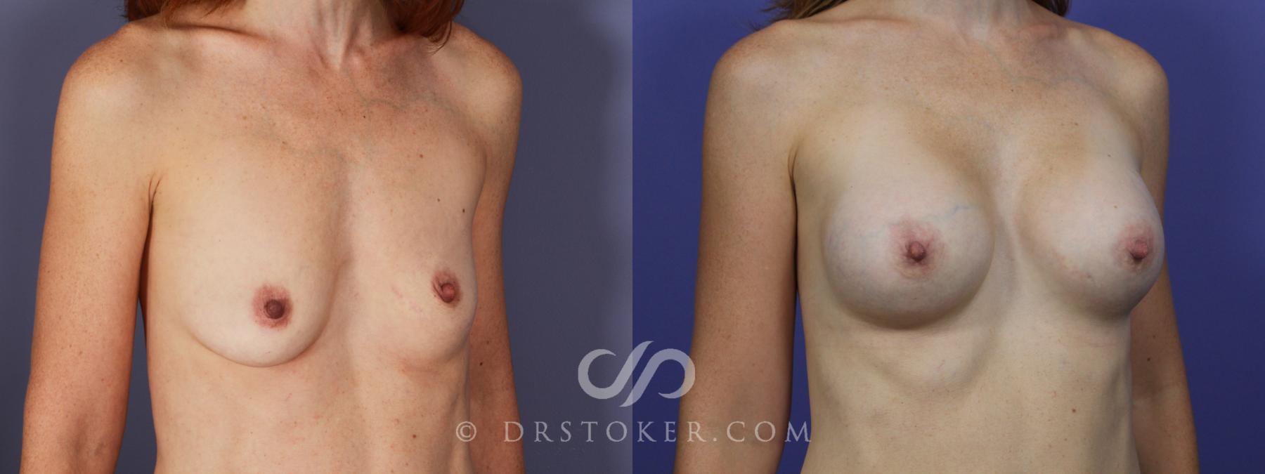 Before & After Breast Augmentation, Rapid Recovery Case 1268 View #2 View in Los Angeles, CA